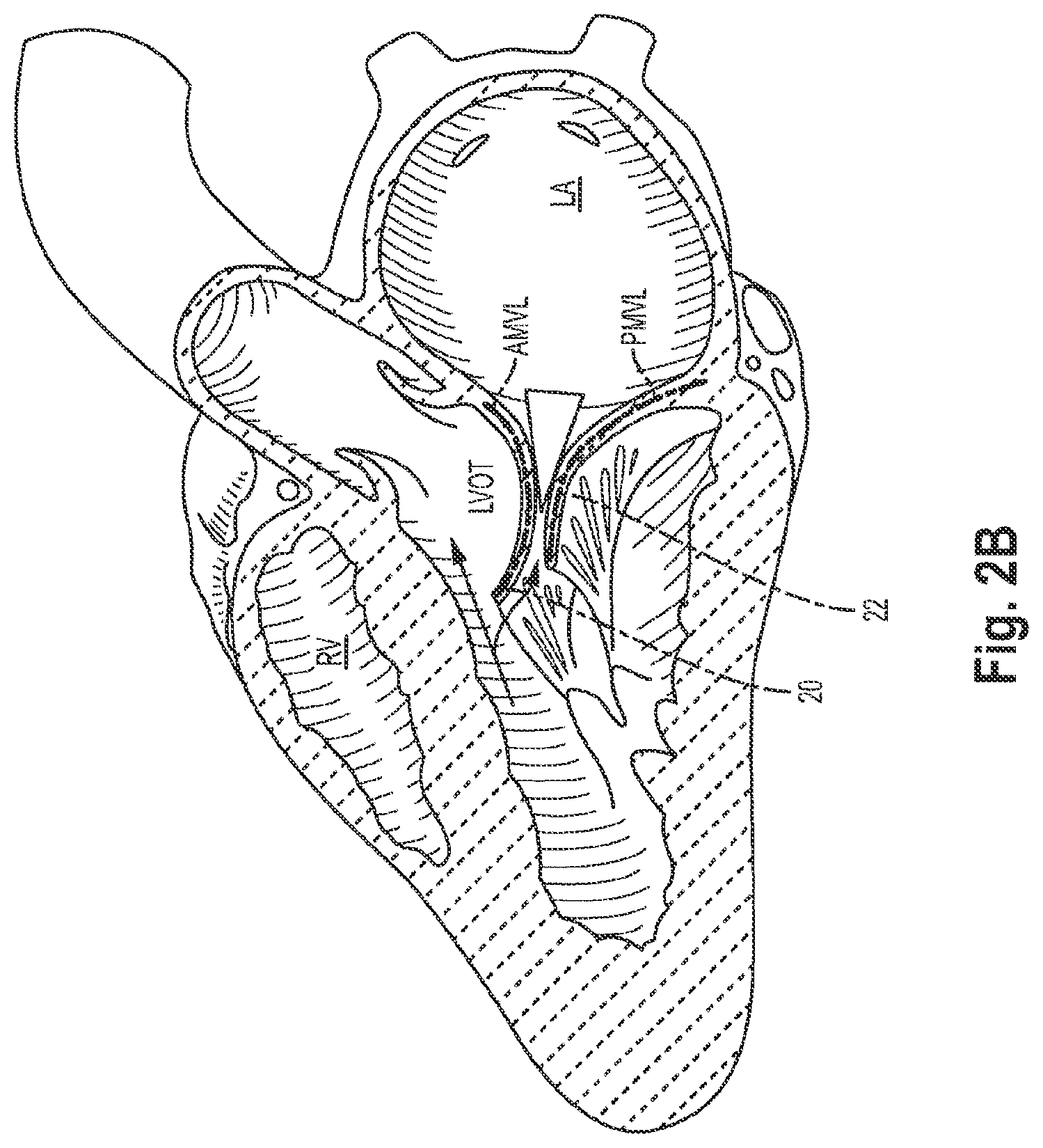 Patent US12551344 Figure 4 – Heart valve sealing devices and delivery devices therefor