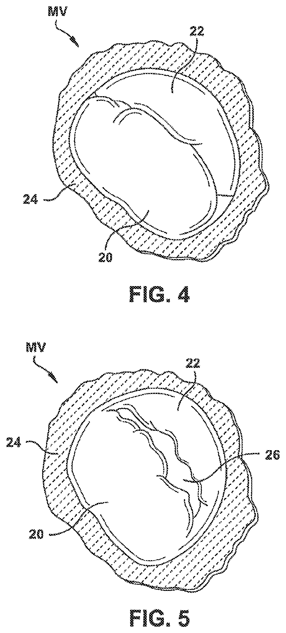 Patent US12551344 Figure 6 – Heart valve sealing devices and delivery devices therefor
