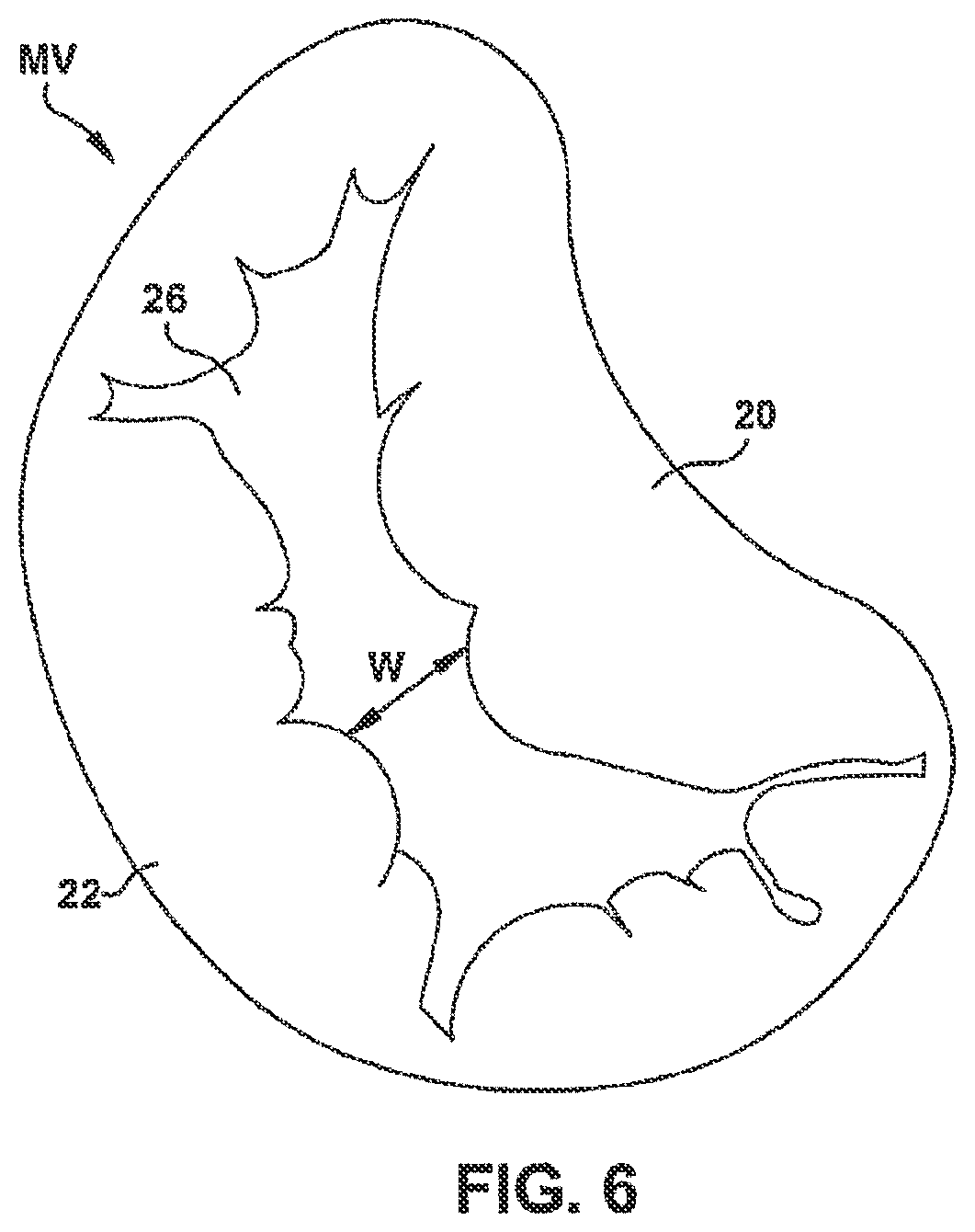 Patent US12551344 Figure 7 – Heart valve sealing devices and delivery devices therefor