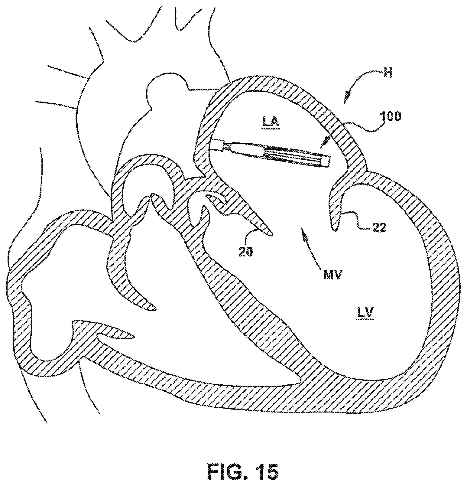Patent US12551344 Figure 16 – Heart valve sealing devices and delivery devices therefor