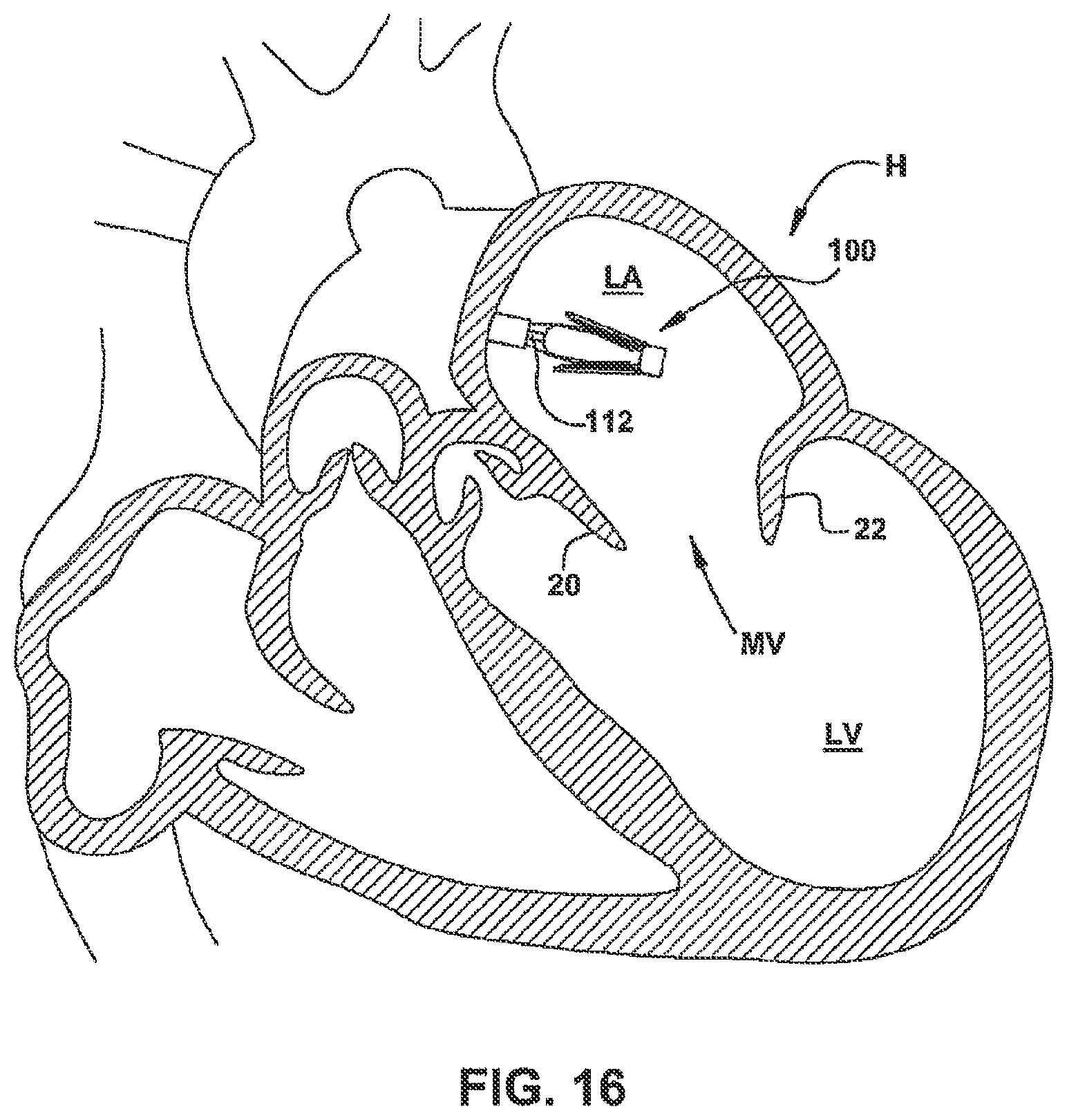 Patent US12551344 Figure 17 – Heart valve sealing devices and delivery devices therefor
