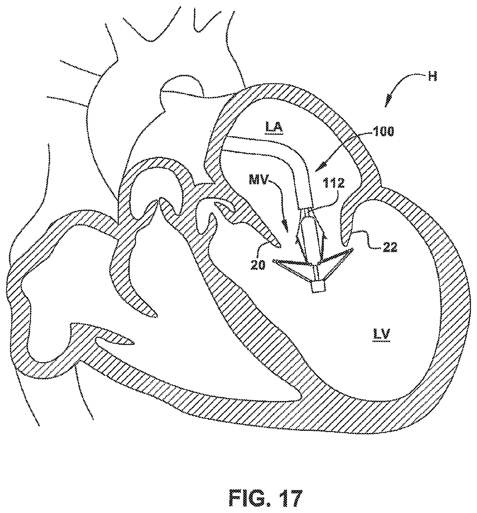 Patent US12551344 Figure 18 – Heart valve sealing devices and delivery devices therefor