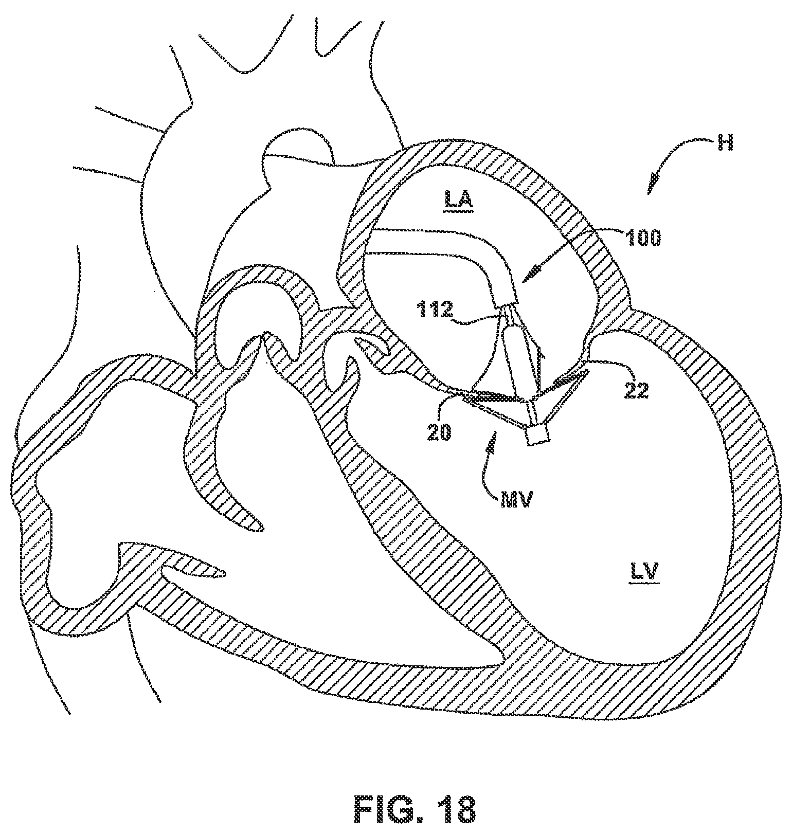 Patent US12551344 Figure 19 – Heart valve sealing devices and delivery devices therefor