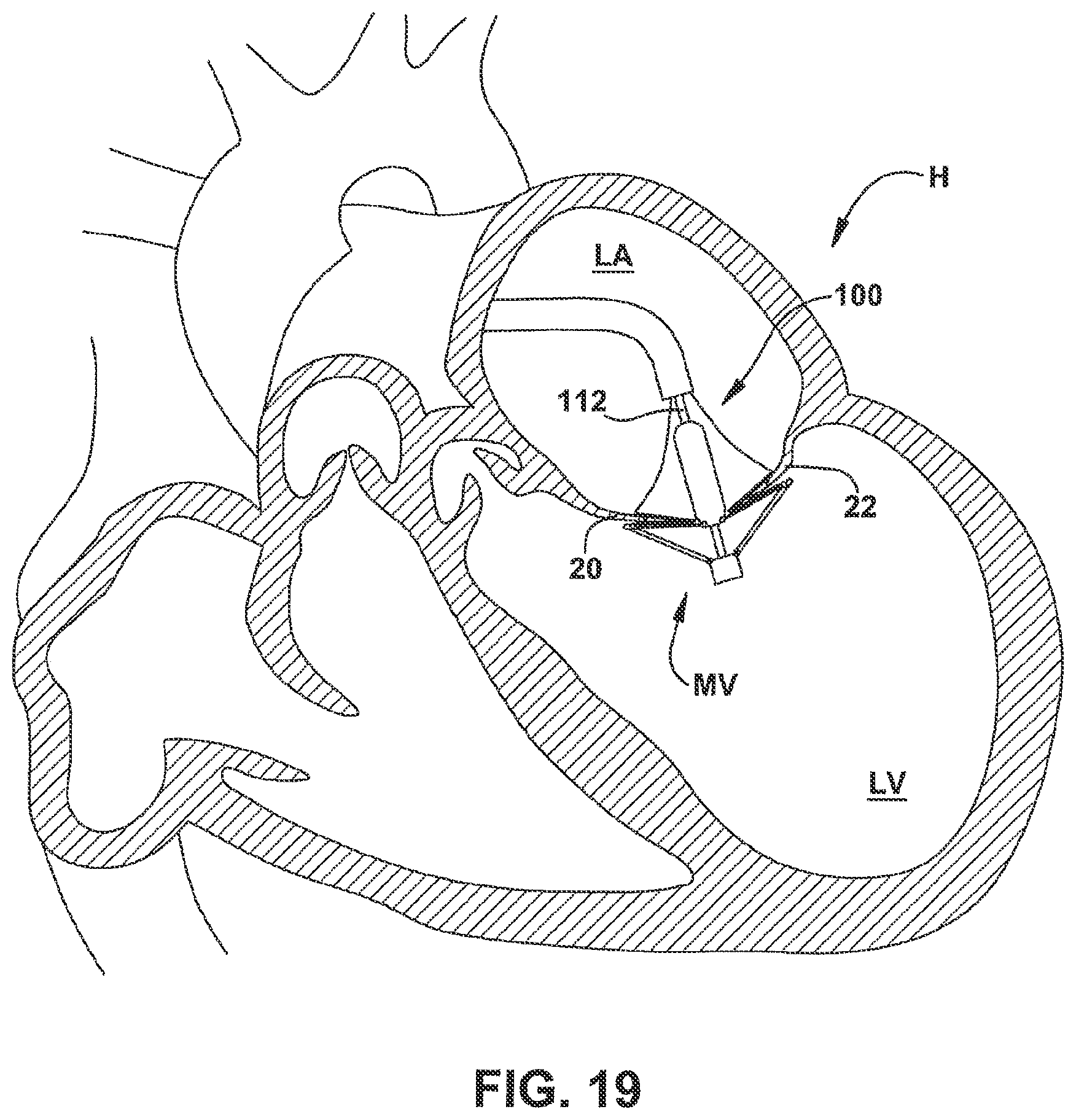 Patent US12551344 Figure 20 – Heart valve sealing devices and delivery devices therefor