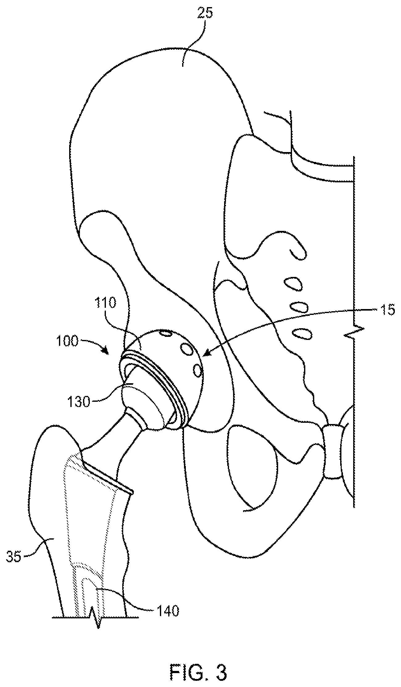 Patent US12551347 Figure 3 – Apparatus and method for forming a custom cement-on-cement articulating hip spacer