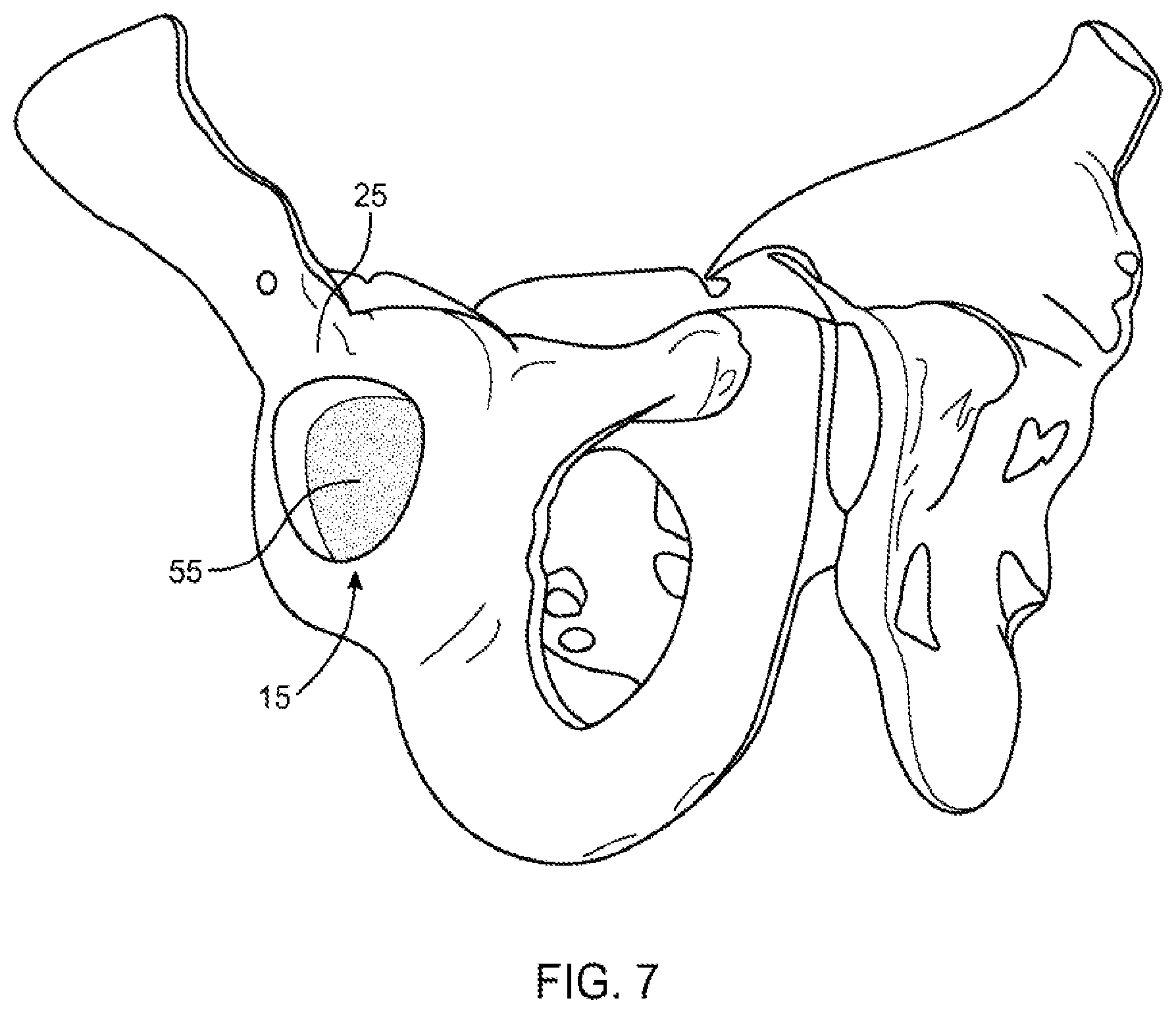 Patent US12551347 Figure 6 – Apparatus and method for forming a custom cement-on-cement articulating hip spacer