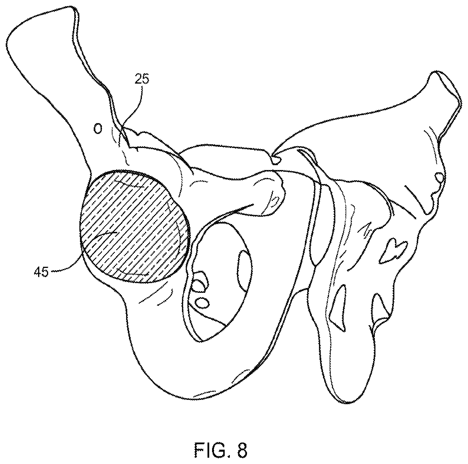 Patent US12551347 Figure 7 – Apparatus and method for forming a custom cement-on-cement articulating hip spacer