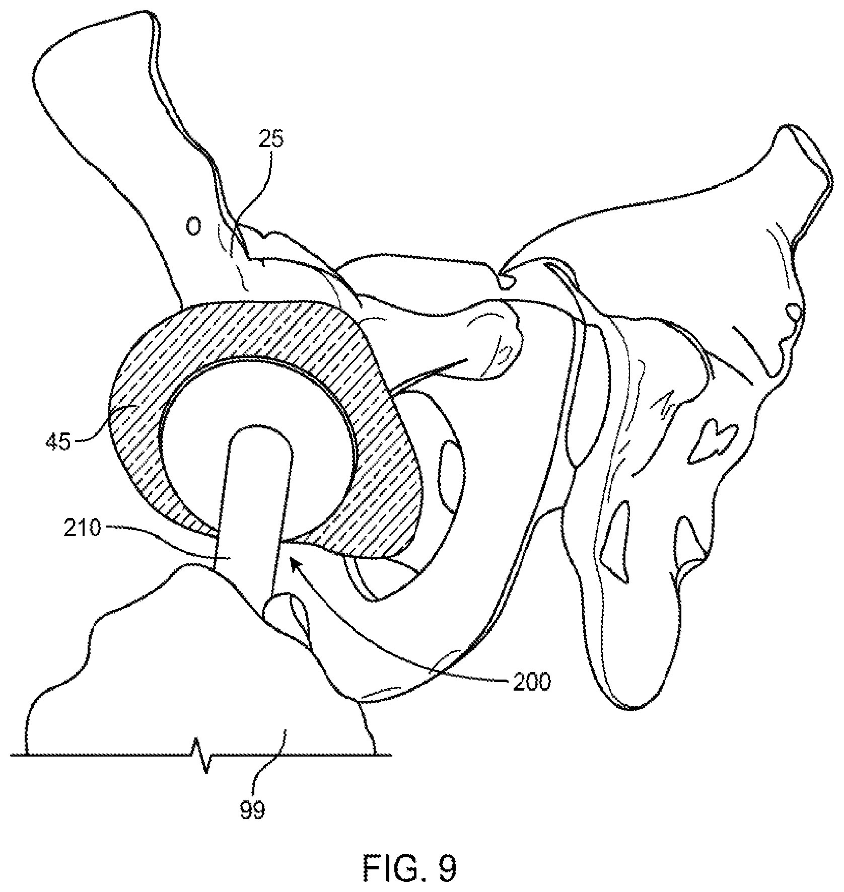 Patent US12551347 Figure 8 – Apparatus and method for forming a custom cement-on-cement articulating hip spacer