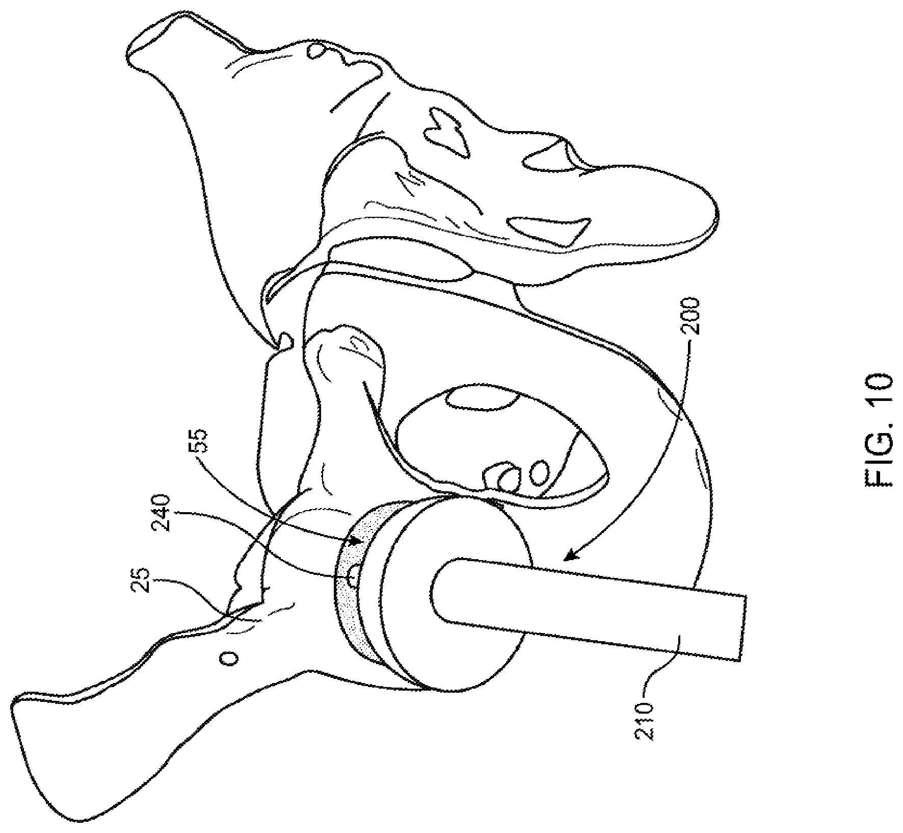 Patent US12551347 Figure 9 – Apparatus and method for forming a custom cement-on-cement articulating hip spacer