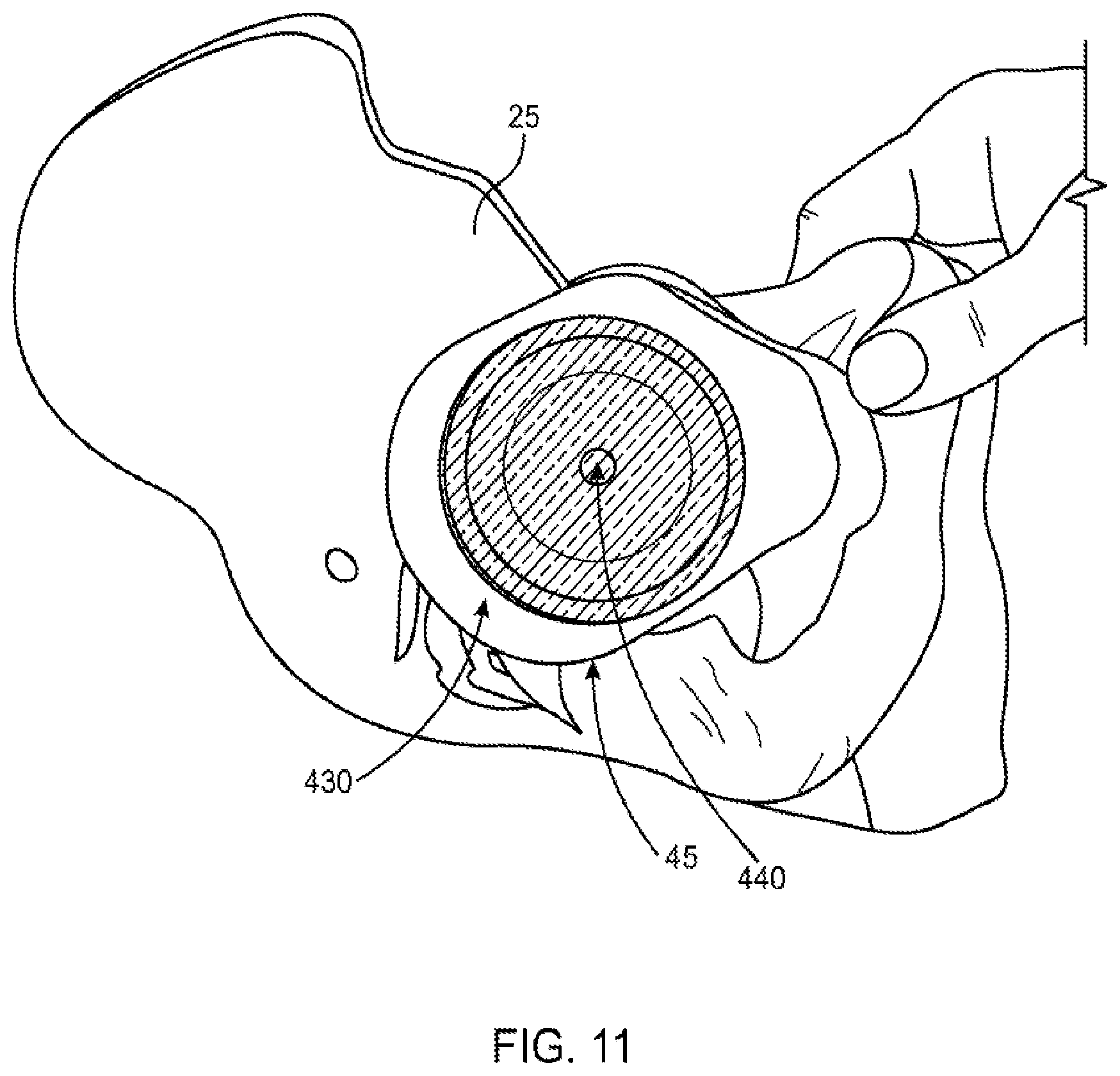 Patent US12551347 Figure 10 – Apparatus and method for forming a custom cement-on-cement articulating hip spacer