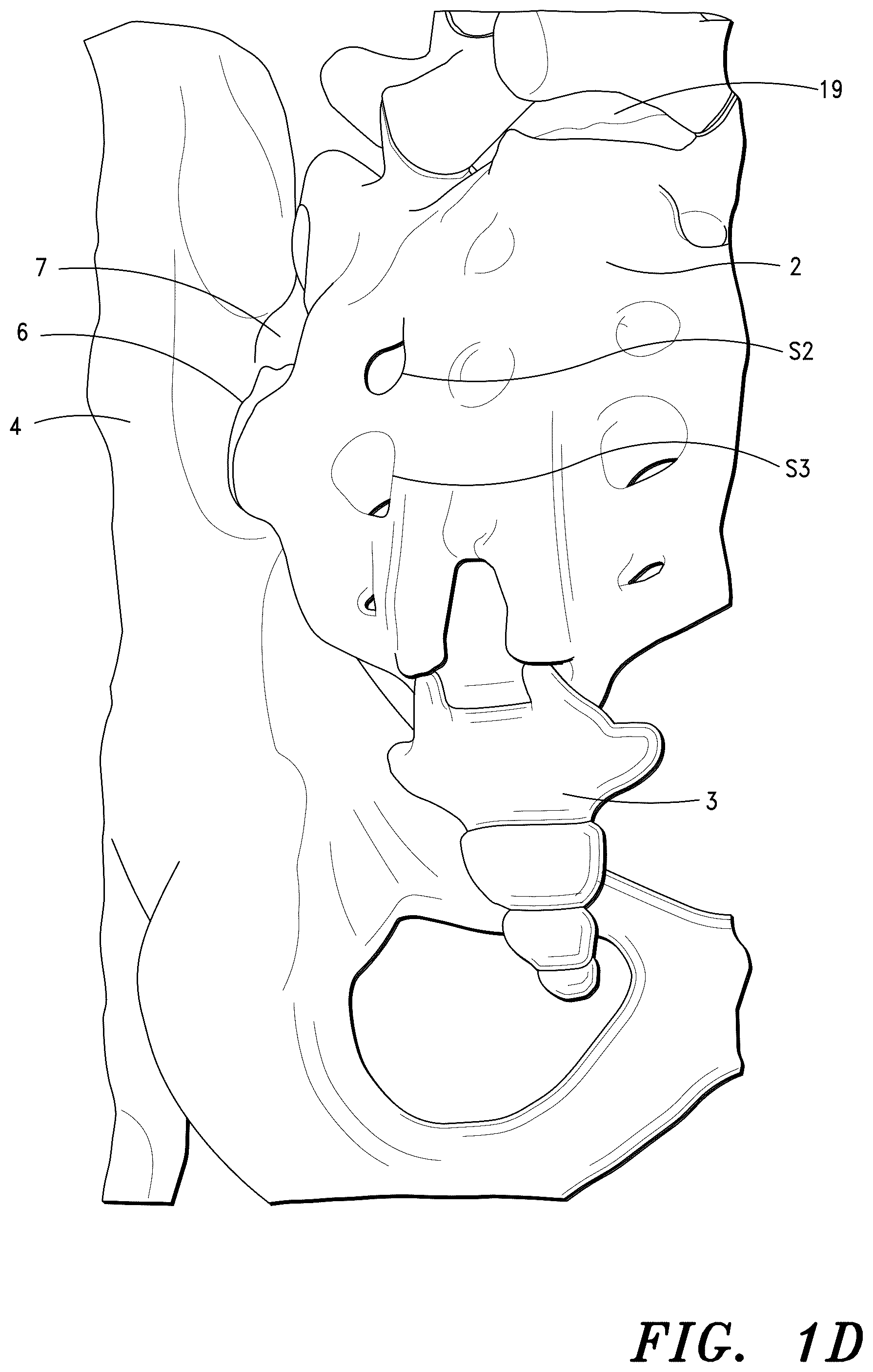 Patent US12551348 Figure 3 – Systems for sacroiliac joint stabilization