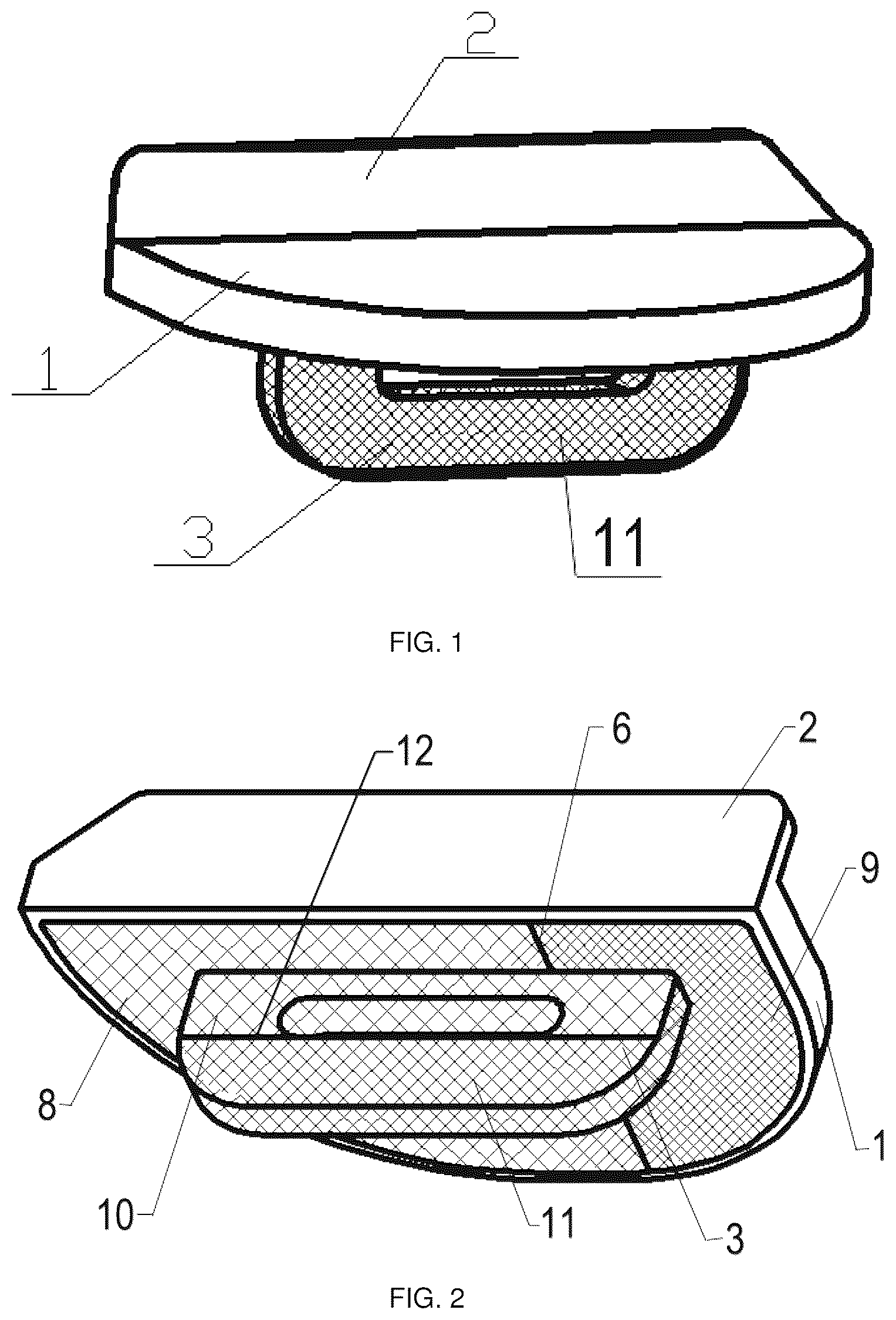 Patent US12551350 — Zonal trabecular uni-compartmental tibial plateau containing zirconium-niobium alloy on oxidation layer and preparation method thereof — Figure 1