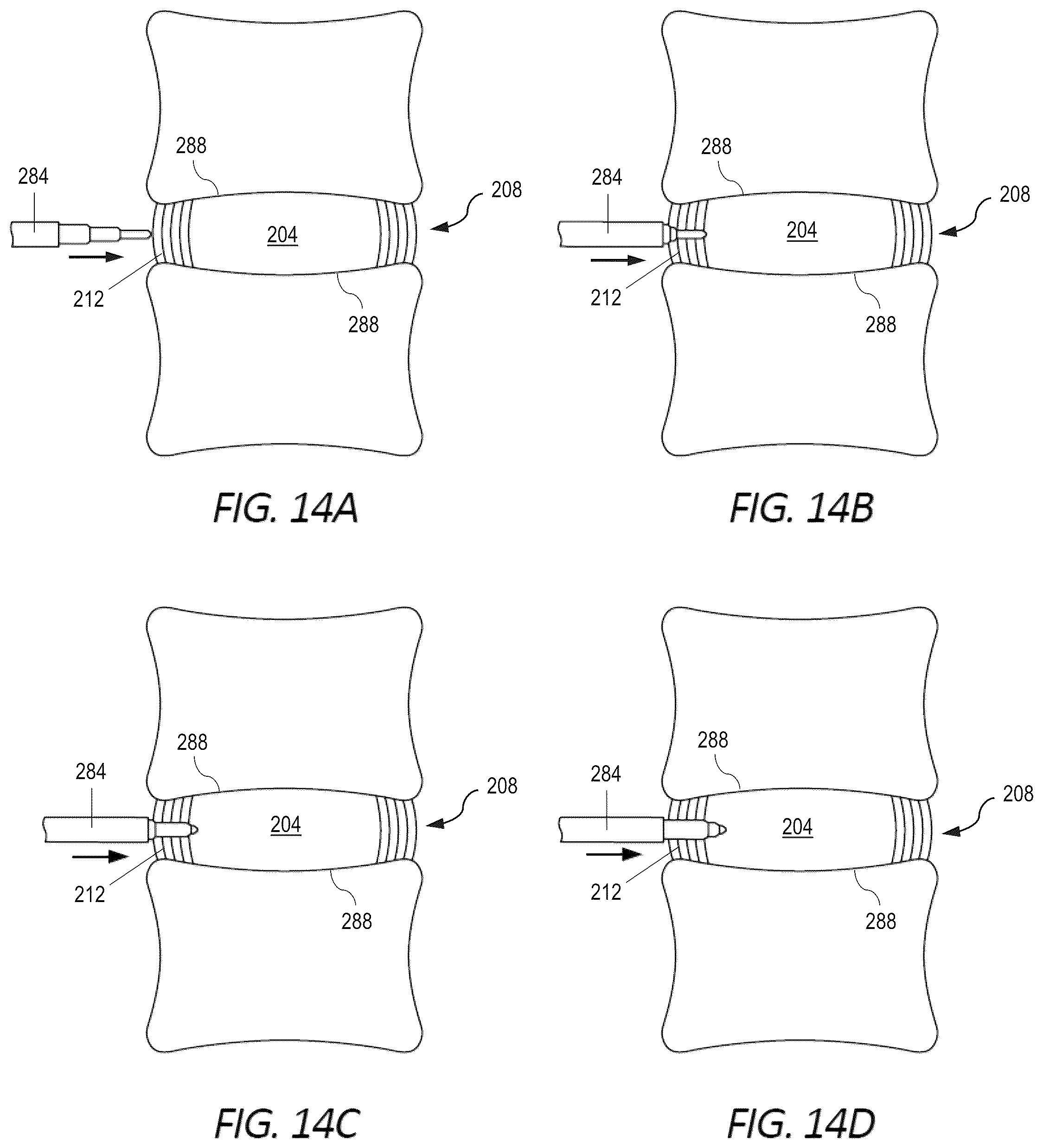 Patent US12551352 Figure 9 – Implantable nuclear prosthesis, kits, and related methods
