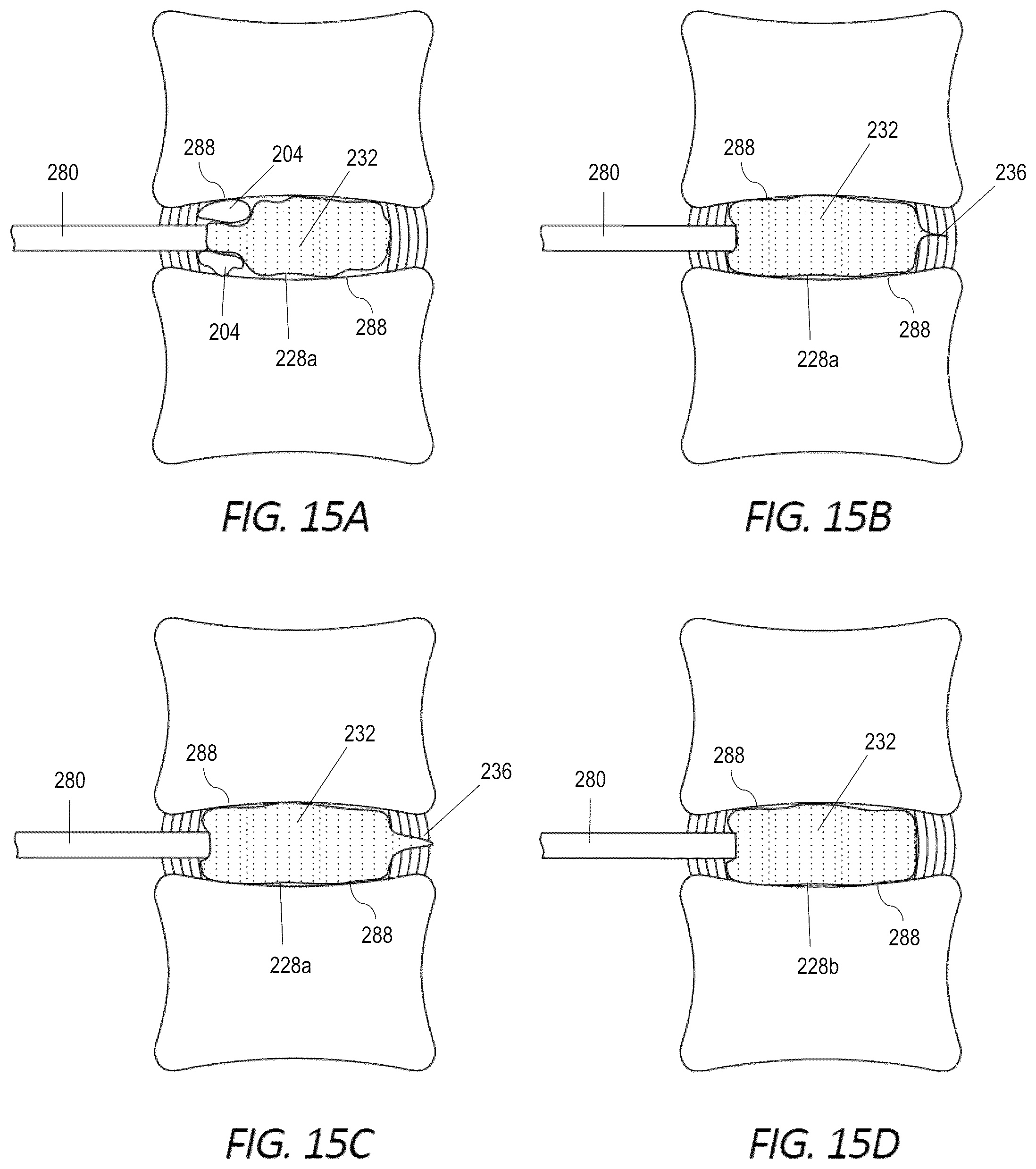 Patent US12551352 Figure 10 – Implantable nuclear prosthesis, kits, and related methods