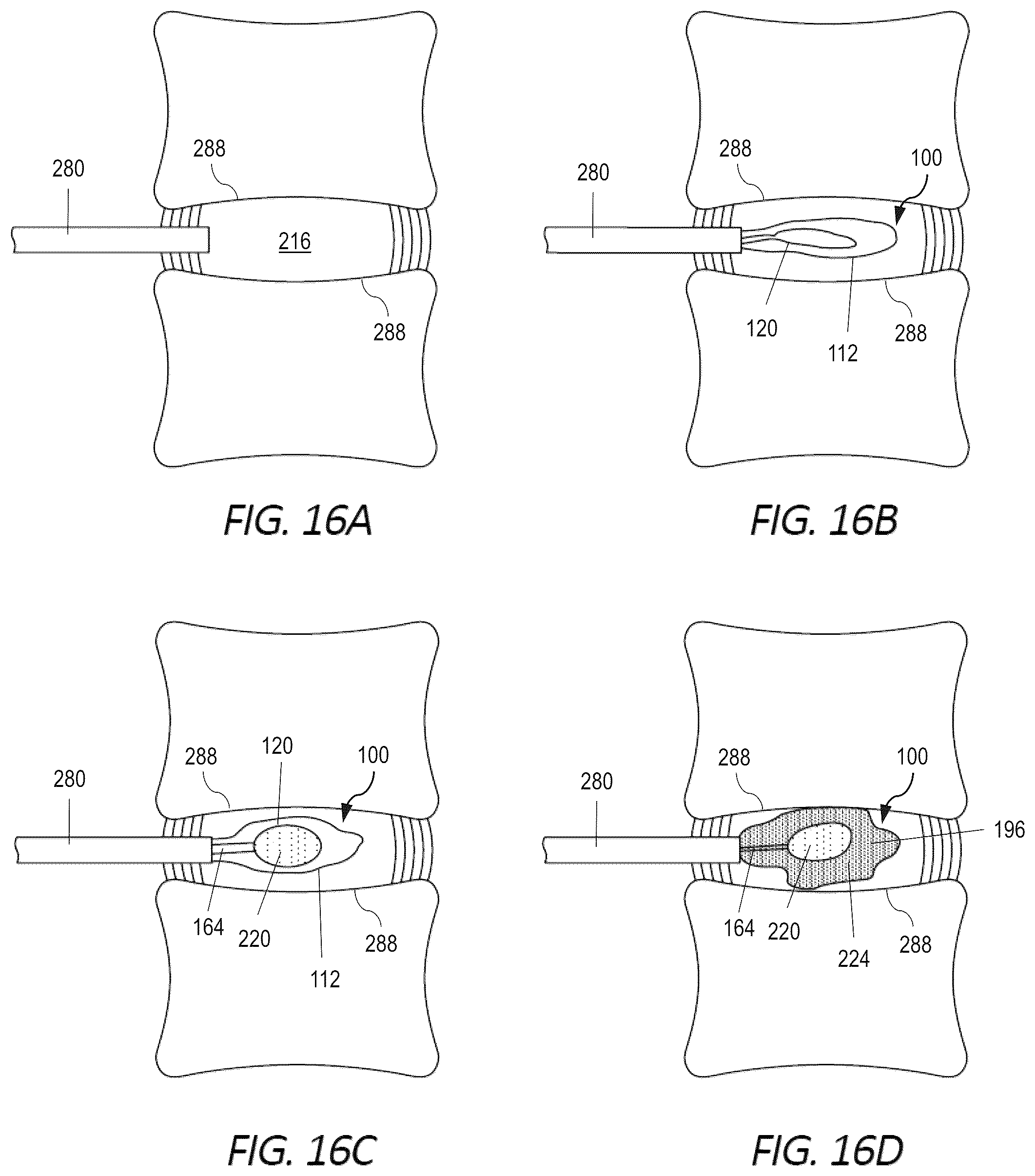 Patent US12551352 Figure 11 – Implantable nuclear prosthesis, kits, and related methods