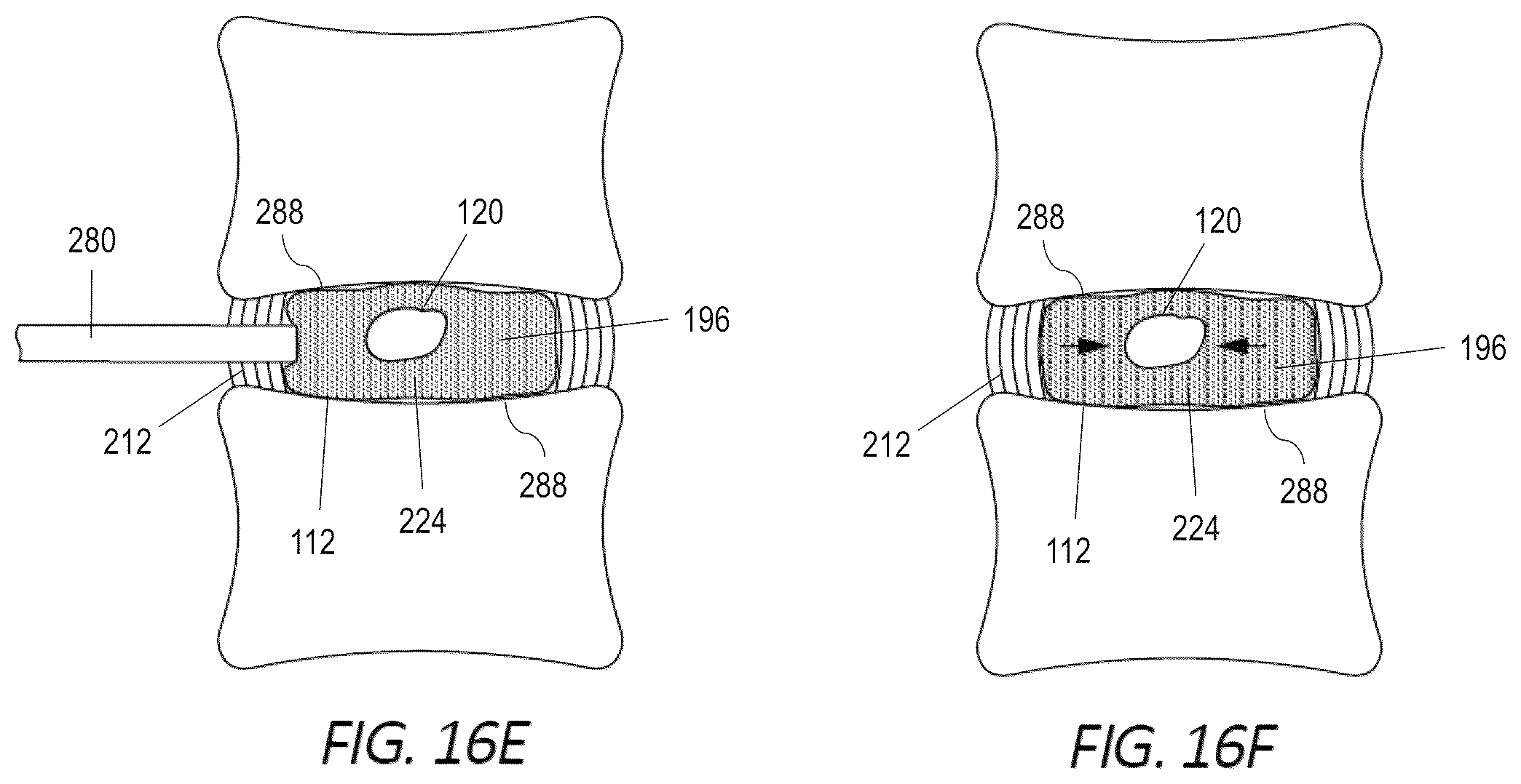Patent US12551352 Figure 12 – Implantable nuclear prosthesis, kits, and related methods