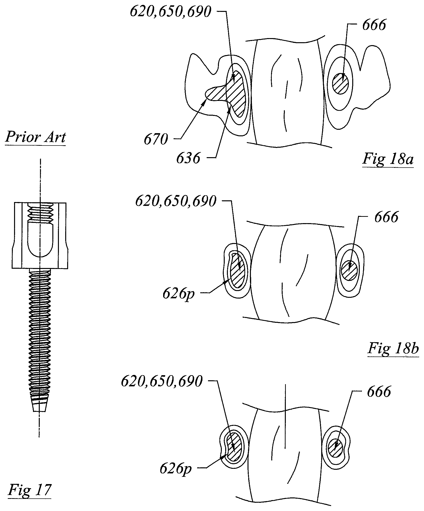 Patent US12551355 Figure 13 – Threadless spinal implant