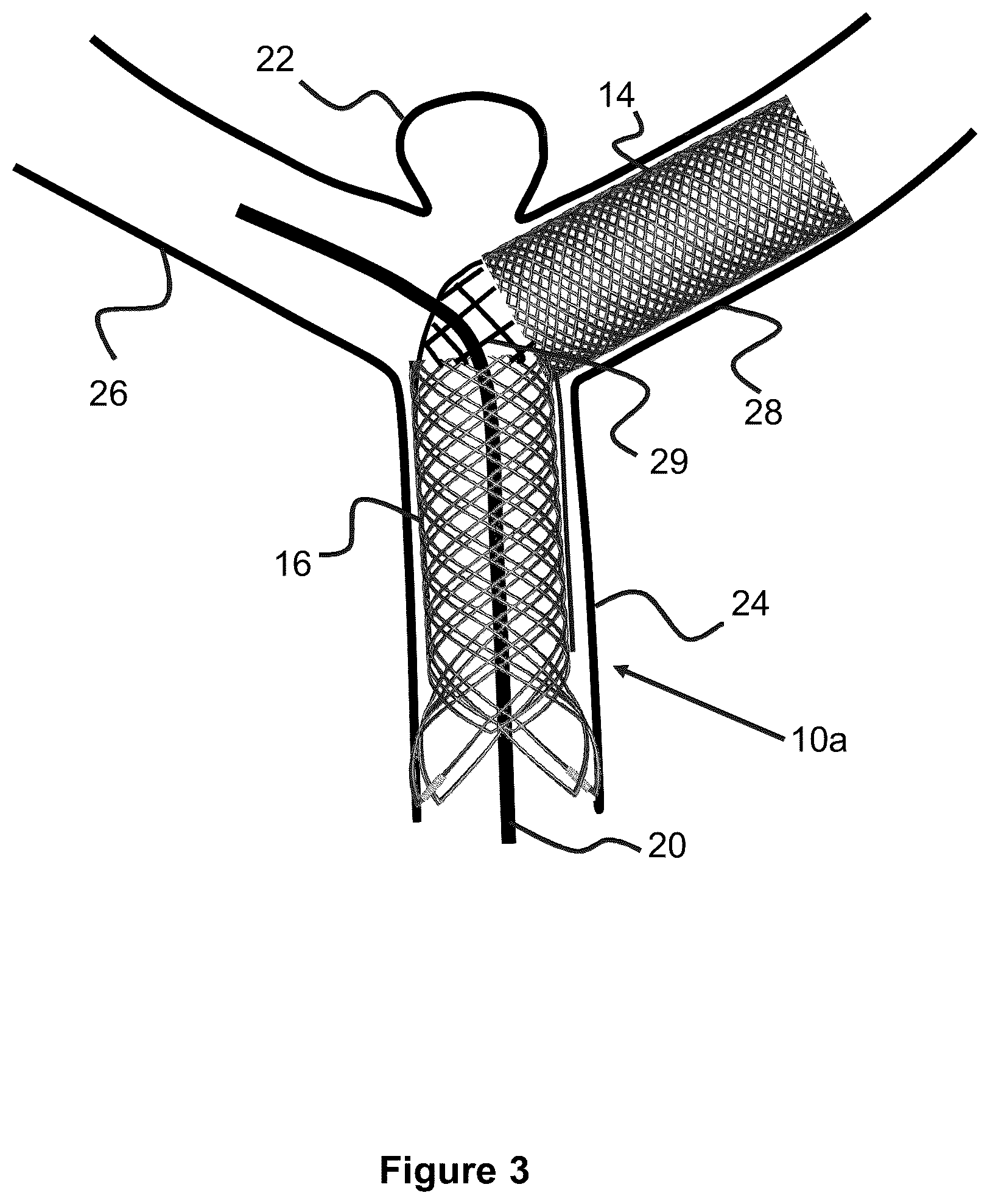 Patent US12551357 Figure 2 – Stent
