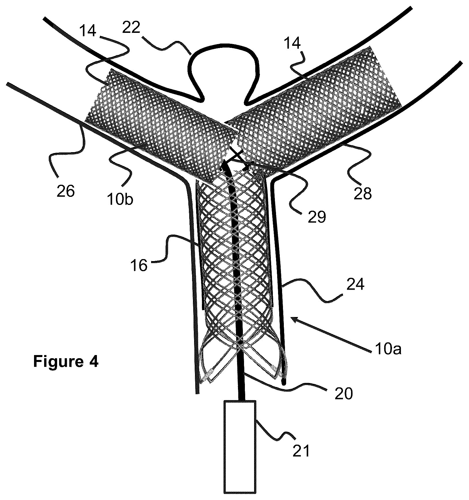 Patent US12551357 Figure 3 – Stent