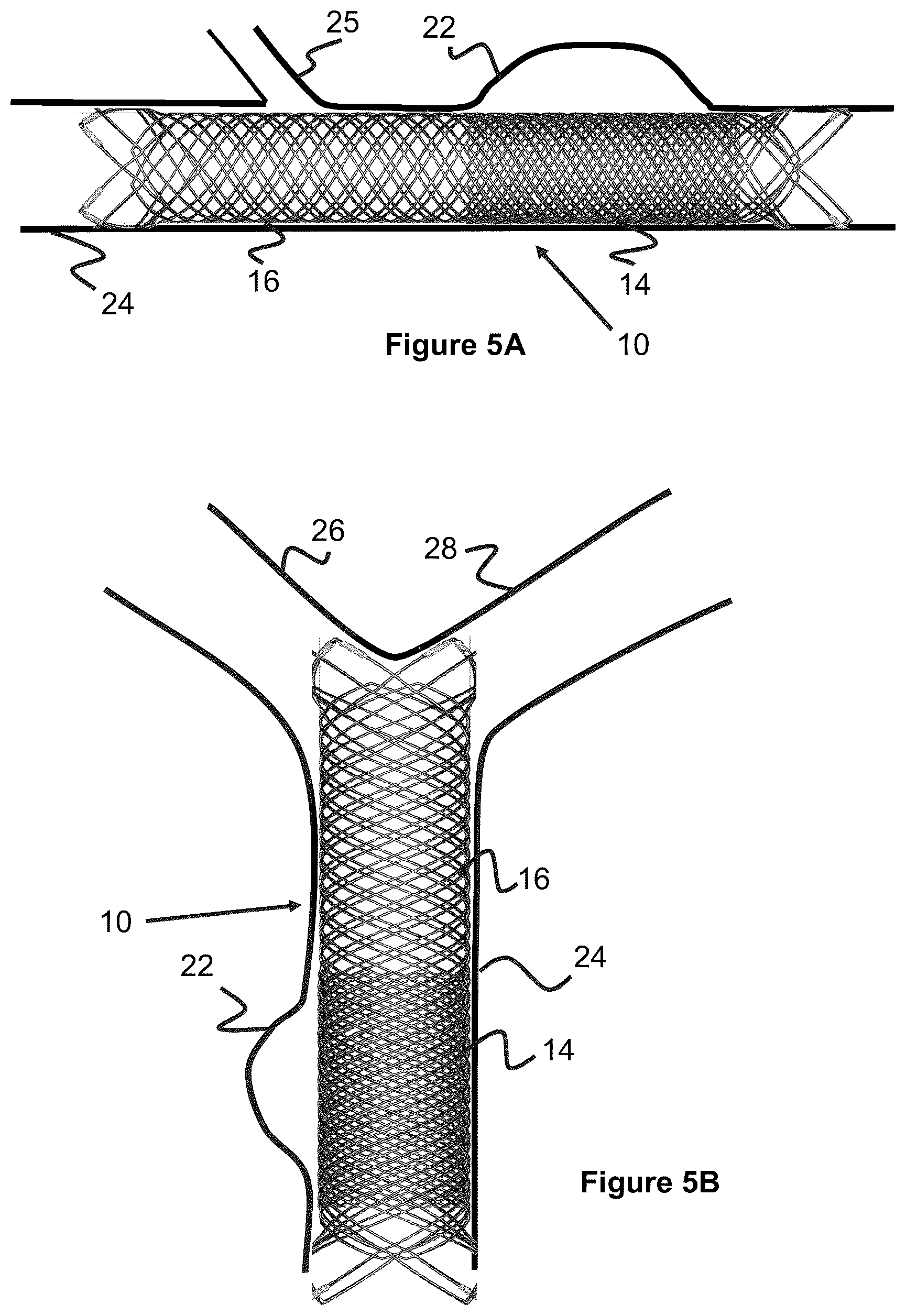 Patent US12551357 Figure 4 – Stent