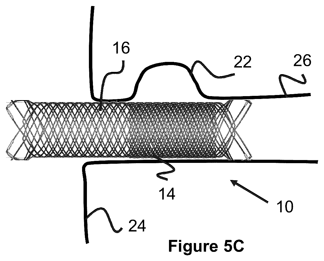 Patent US12551357 Figure 5 – Stent