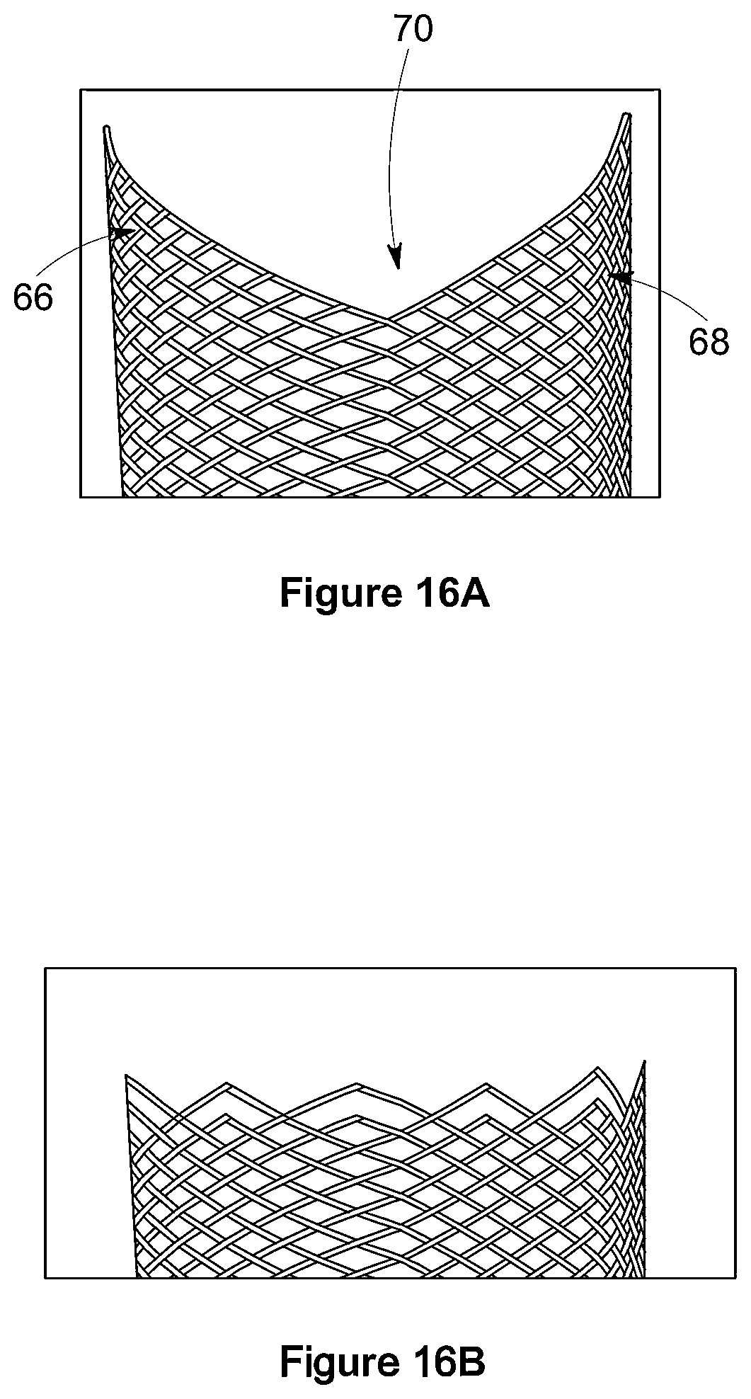 Patent US12551357 Figure 13 – Stent