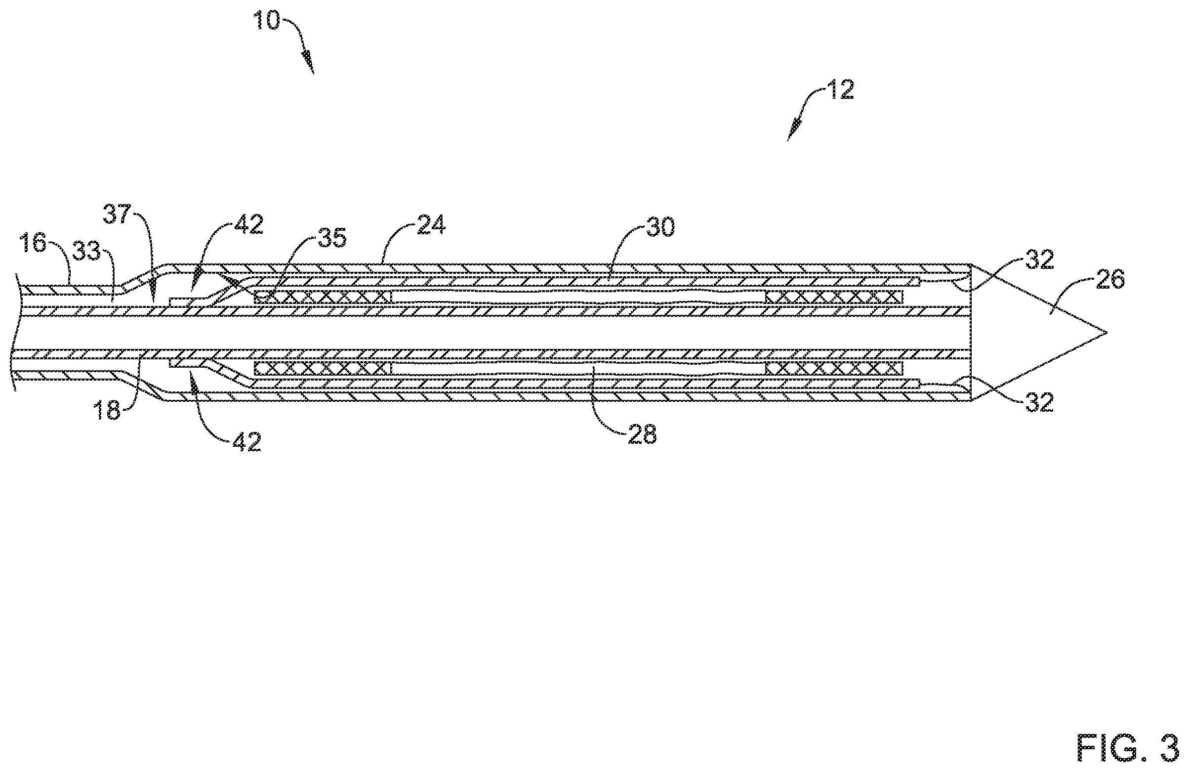 Patent US12551360 Figure 3 – Stent delivery system