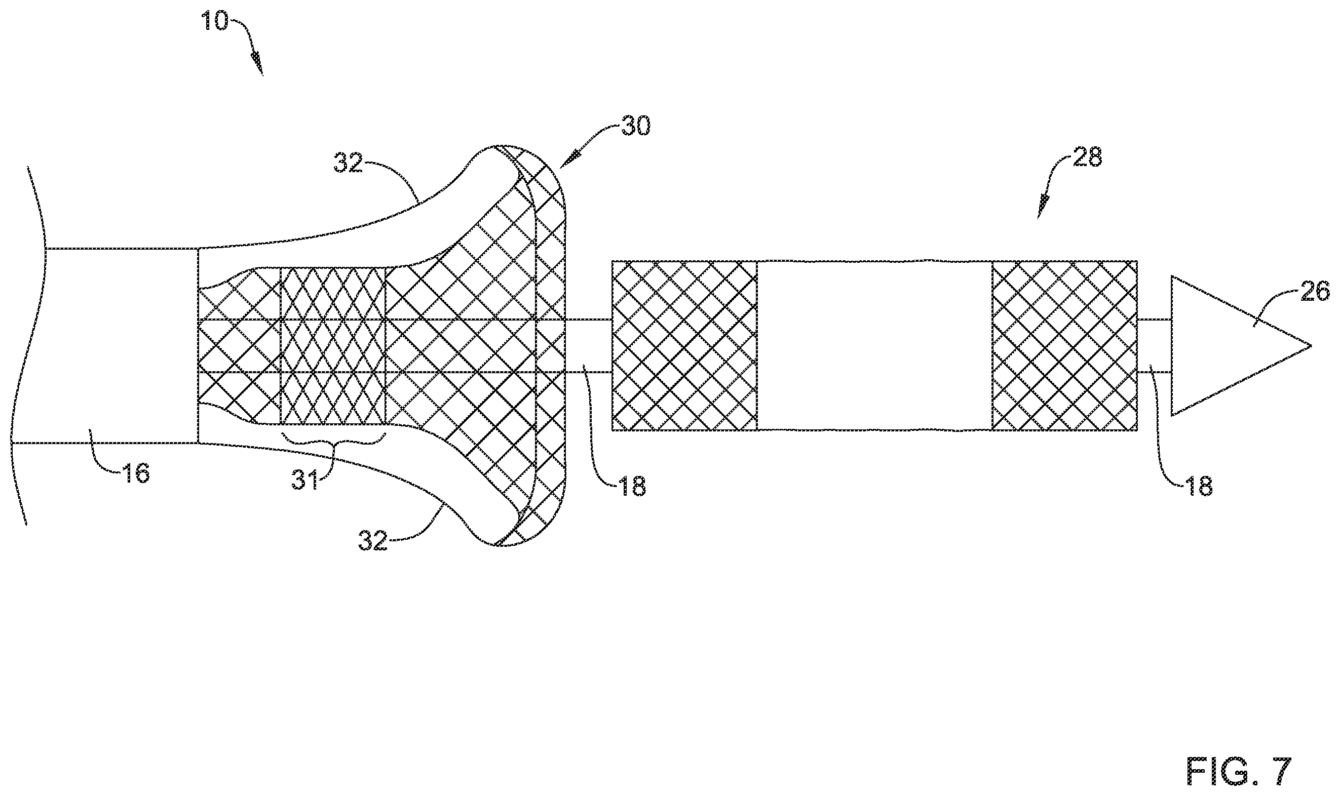 Patent US12551360 Figure 7 – Stent delivery system