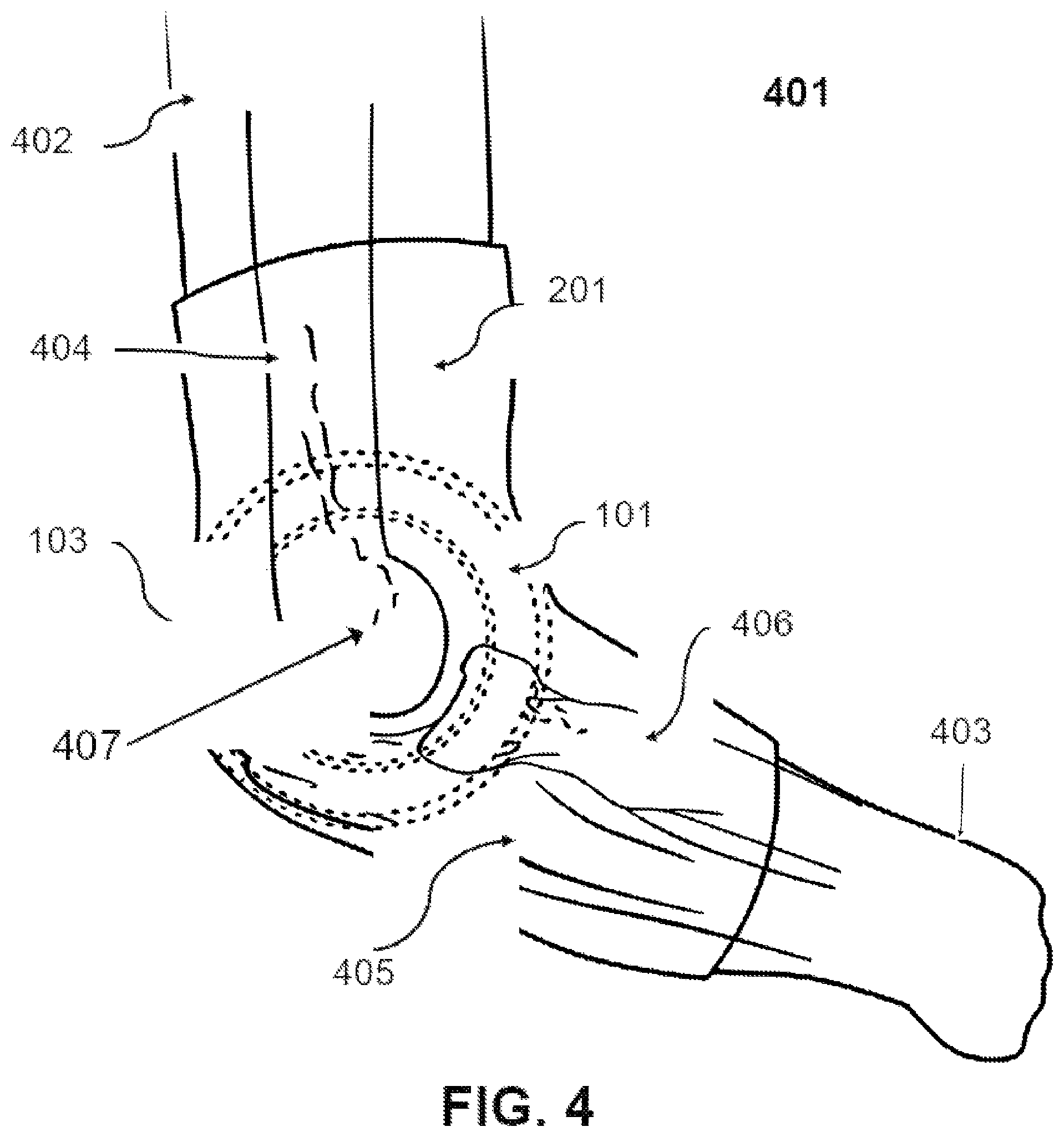 Patent US12551362 Figure 4 – Tennis elbow offloading device