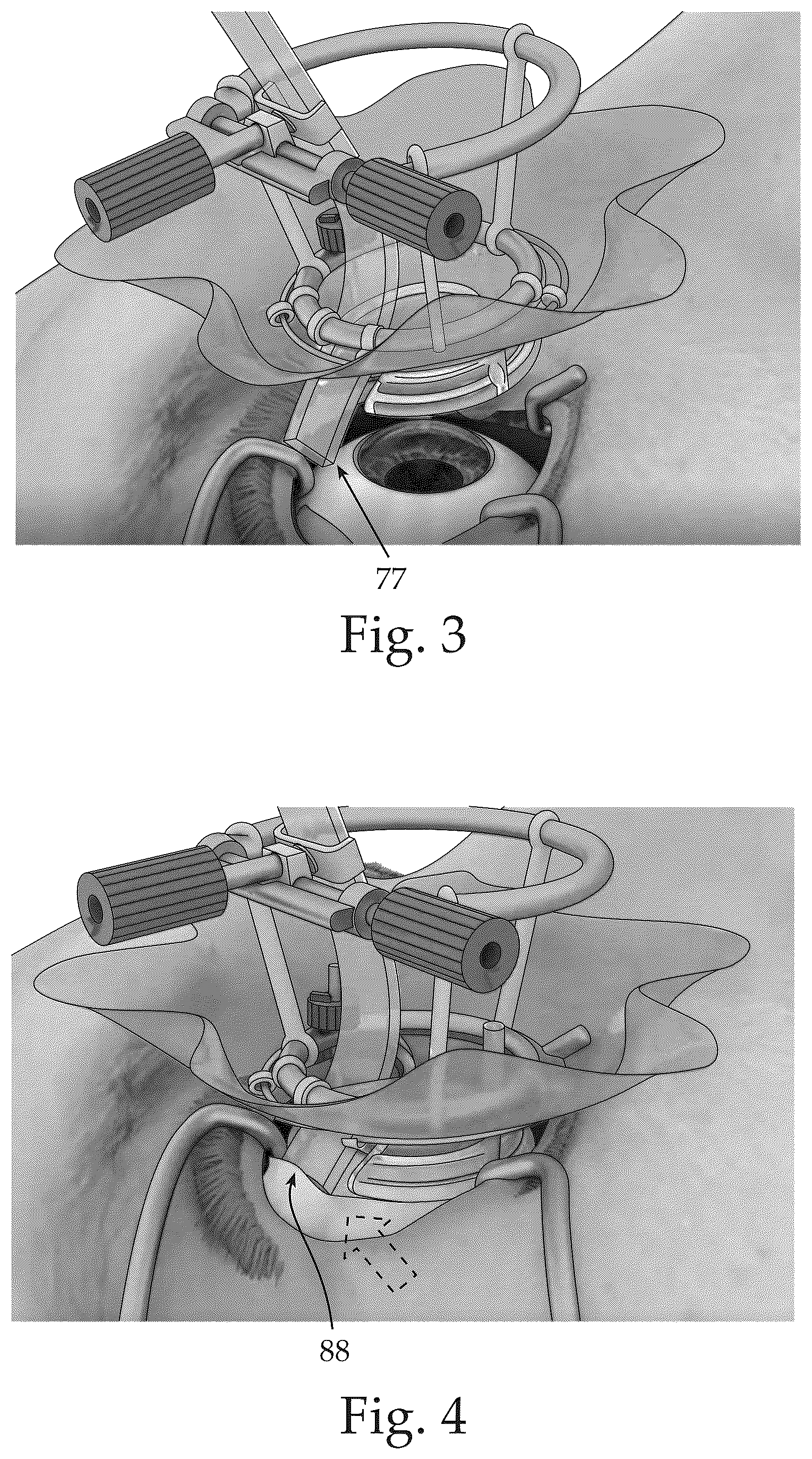 Patent US12551370 Figure 2 – Ocular platforms and surgical tools