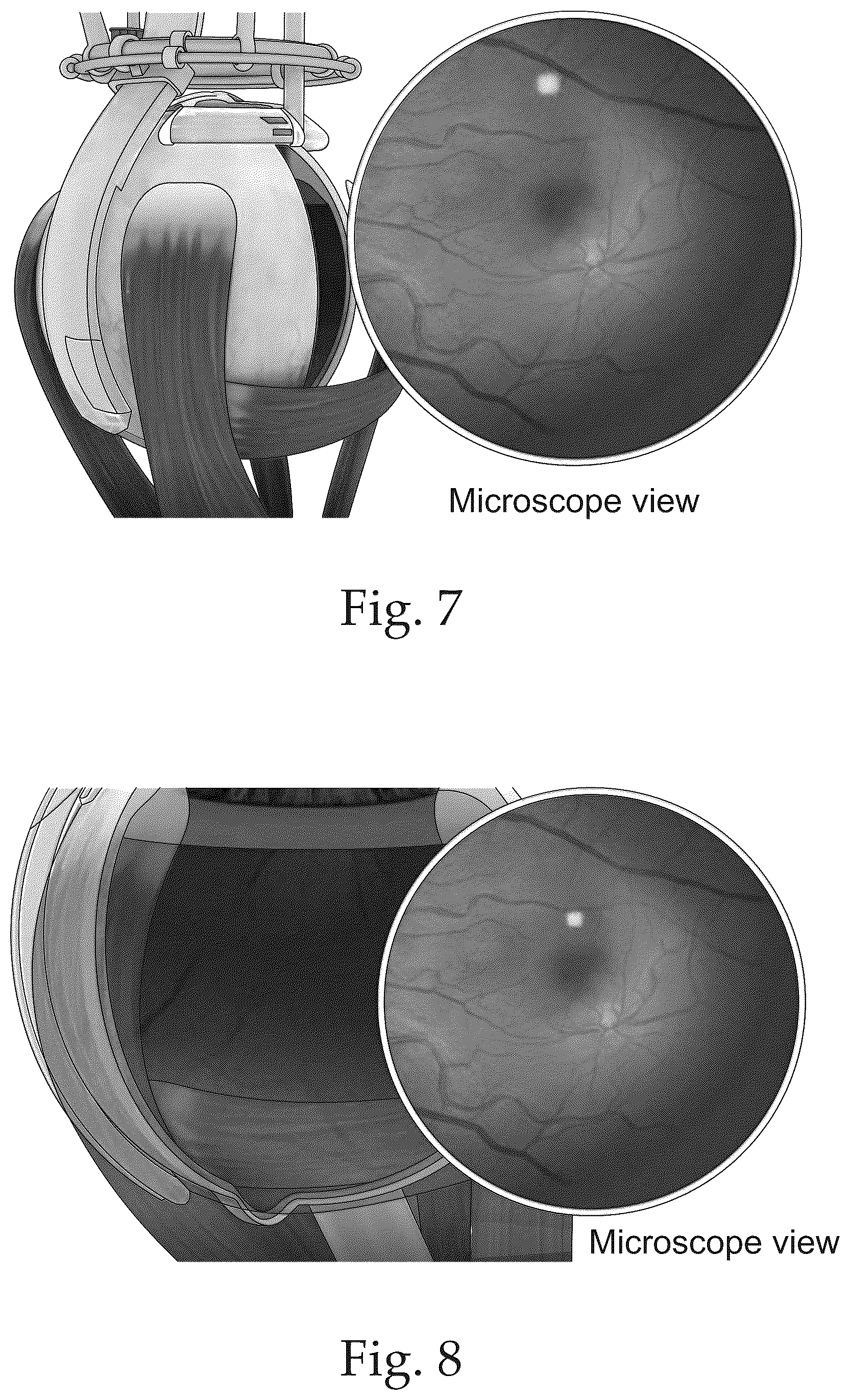 Patent US12551370 Figure 4 – Ocular platforms and surgical tools
