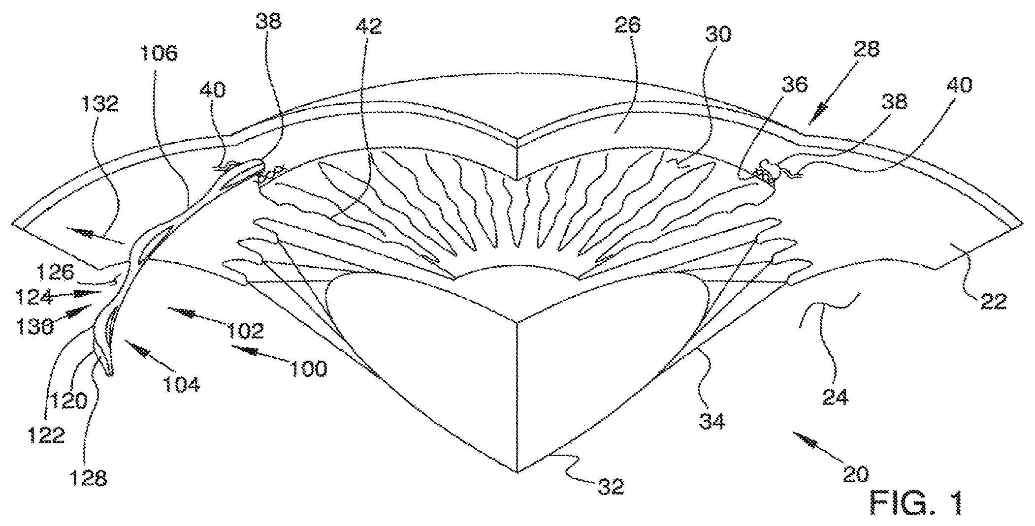 Patent US12551371 — Ocular implant and delivery system — Figure 1