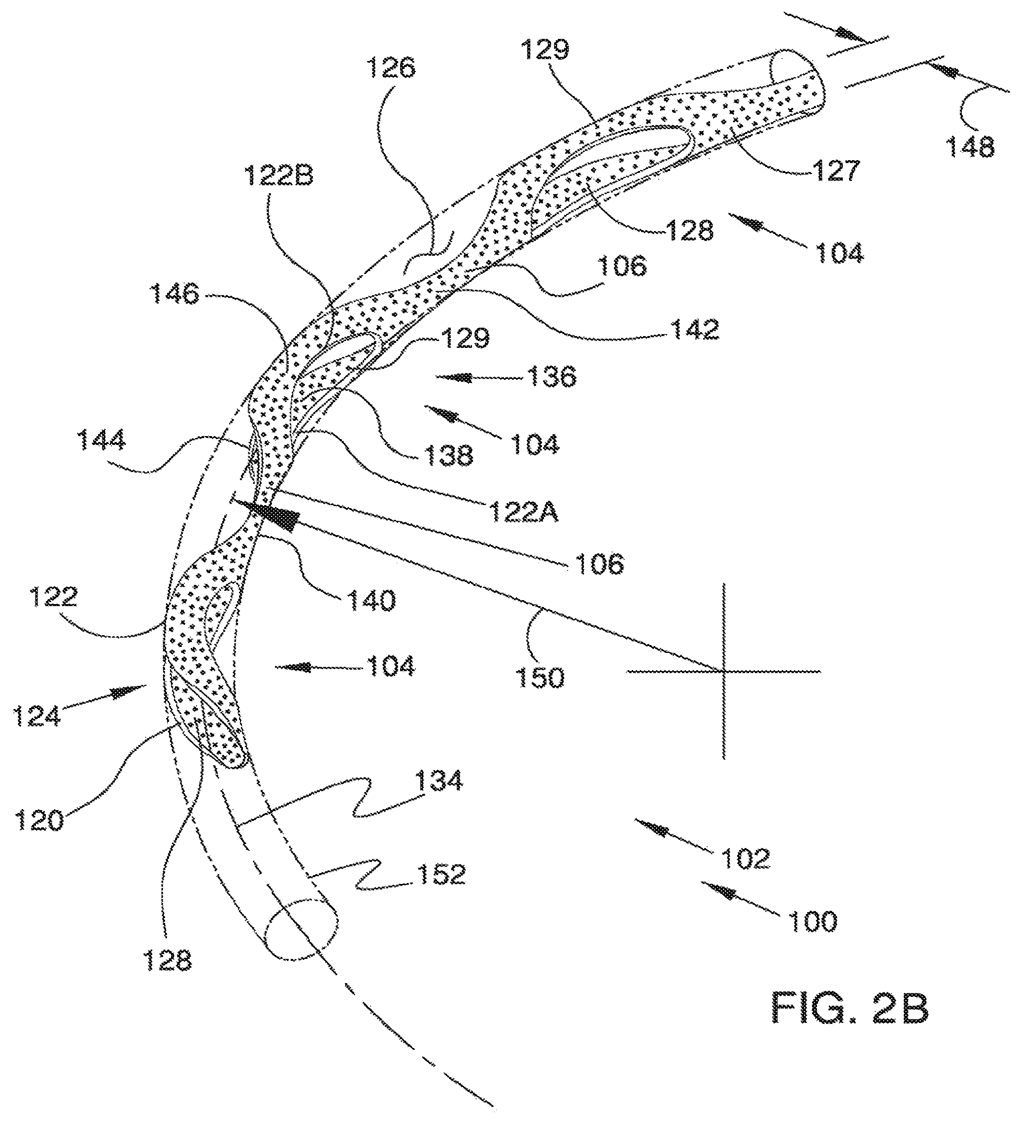Patent US12551371 Figure 3 – Ocular implant and delivery system
