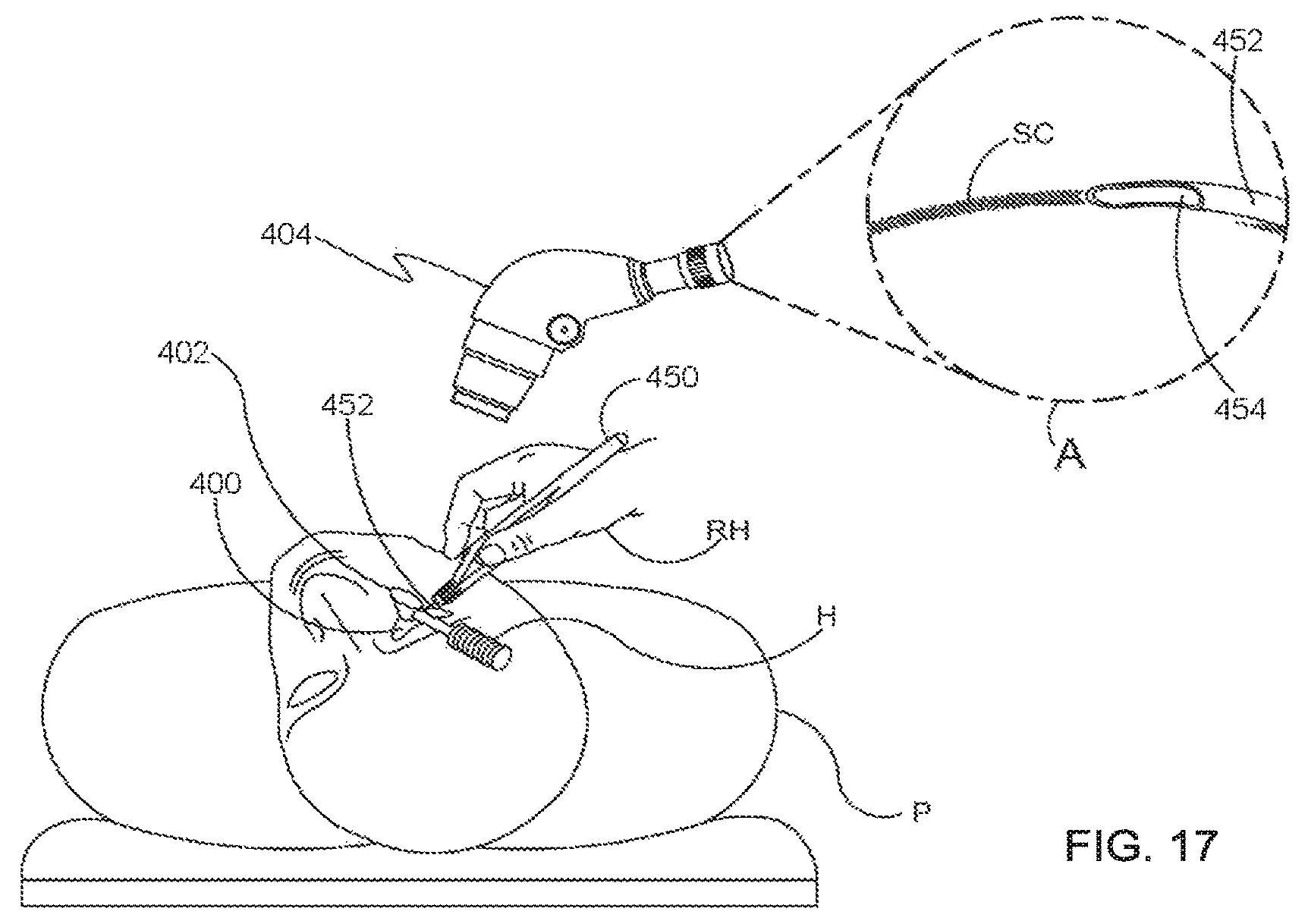 Patent US12551371 Figure 20 – Ocular implant and delivery system