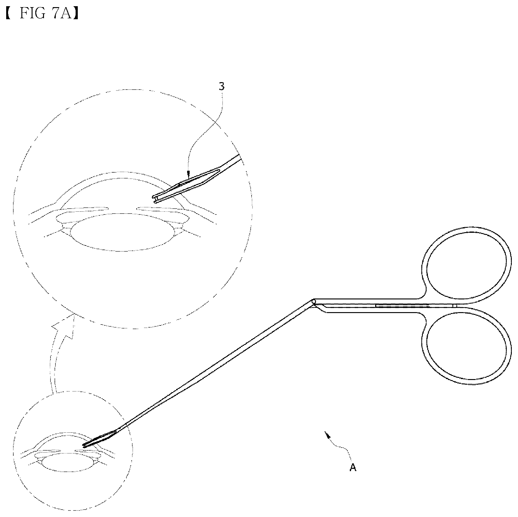 Patent US12551374 Figure 7 – Punching-type iridotomy instrument