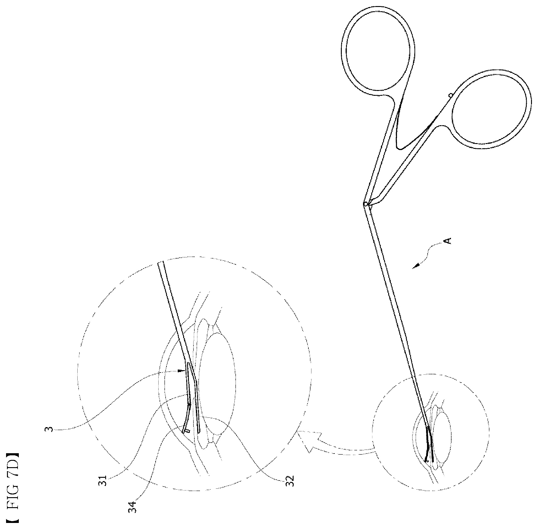 Patent US12551374 Figure 10 – Punching-type iridotomy instrument
