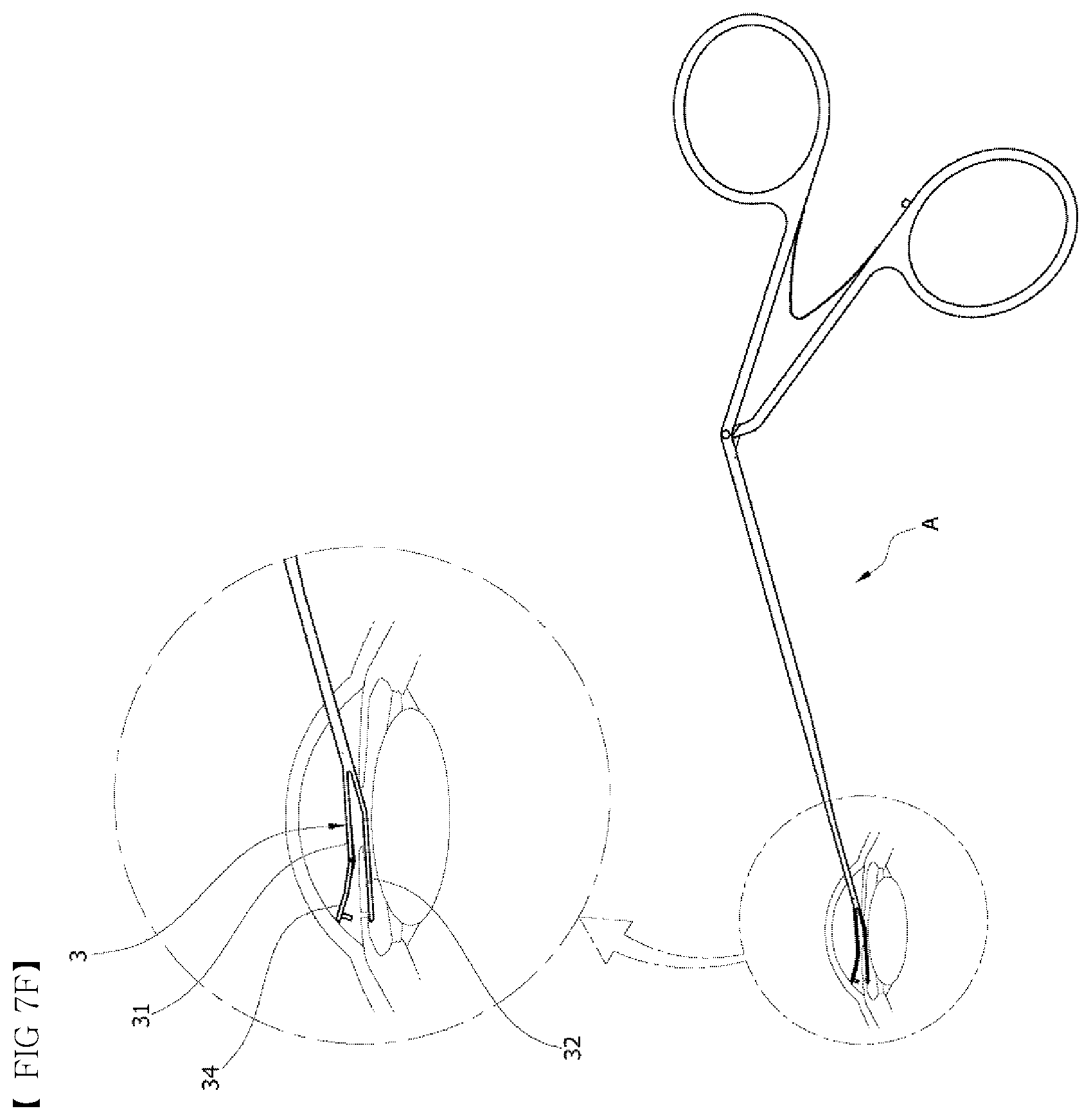 Patent US12551374 Figure 12 – Punching-type iridotomy instrument