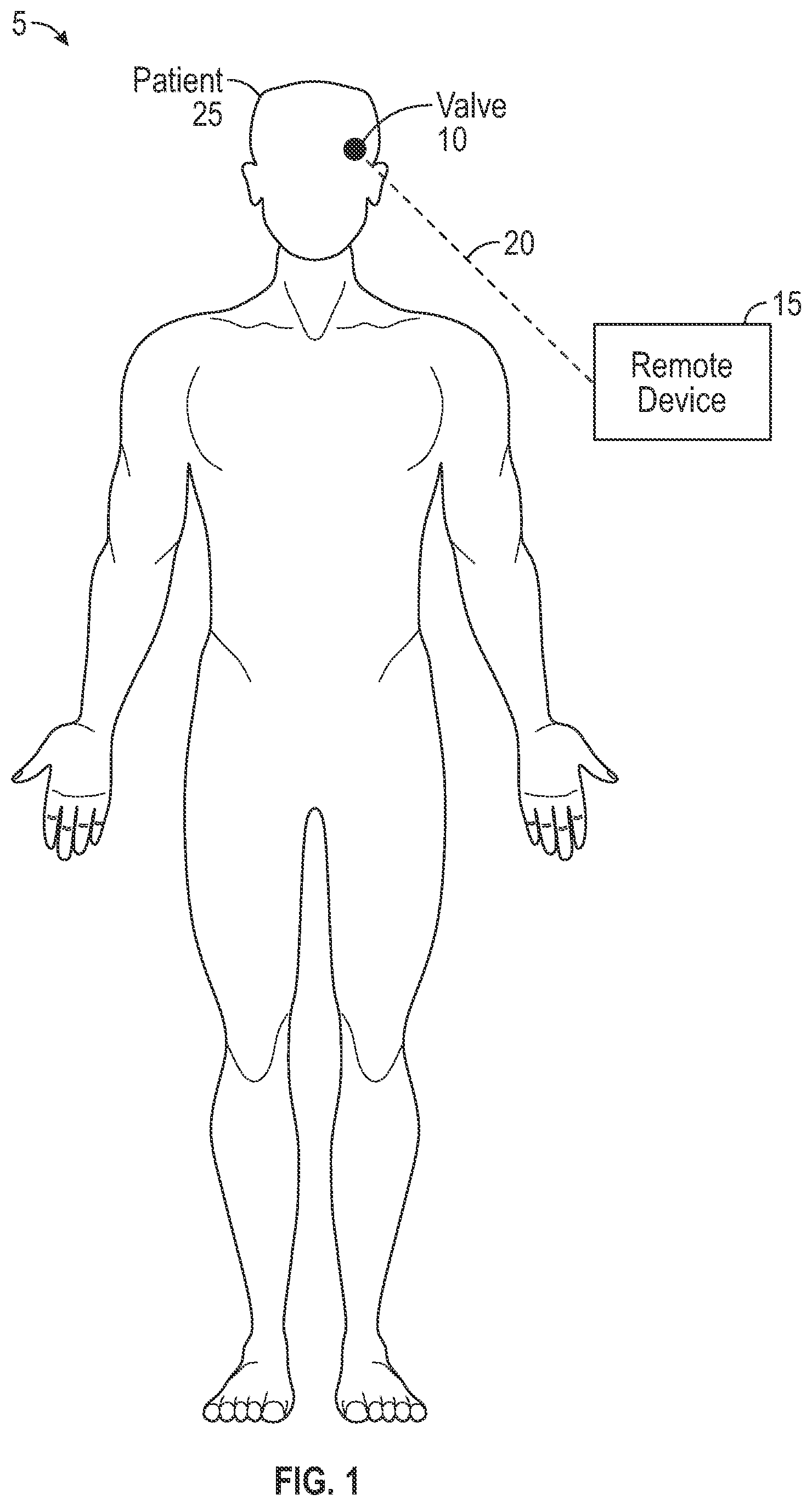 Patent US12551375 Figure 1 – Biofluid shunt valve with sheath and monitoring device