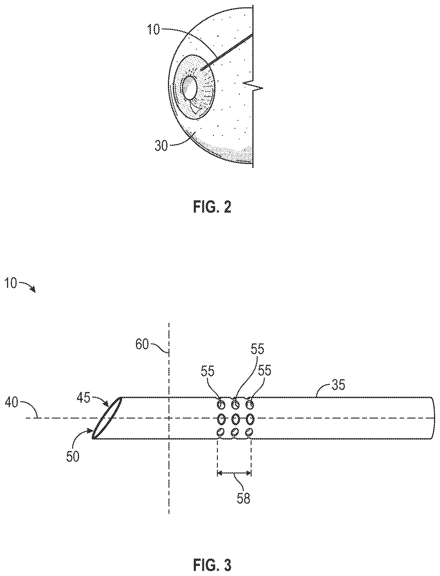 Patent US12551375 Figure 2 – Biofluid shunt valve with sheath and monitoring device
