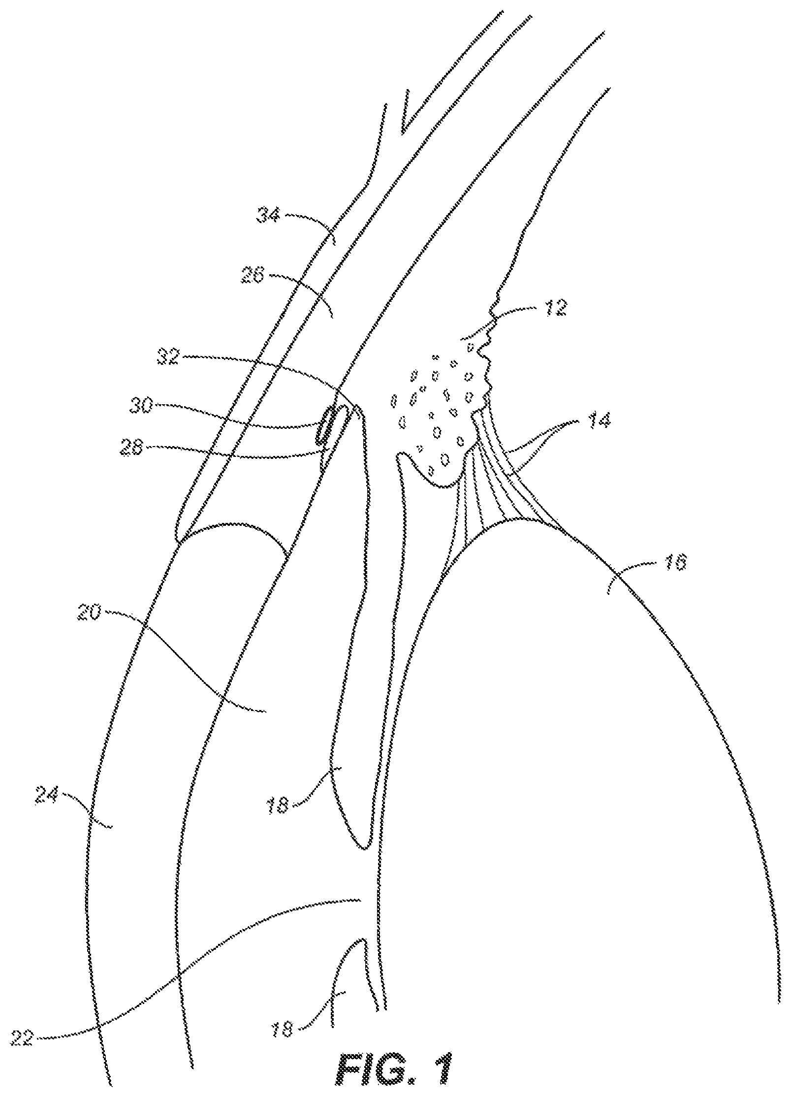 Patent US12551376 Figure 1 – Intraocular implants and methods and kits therefor