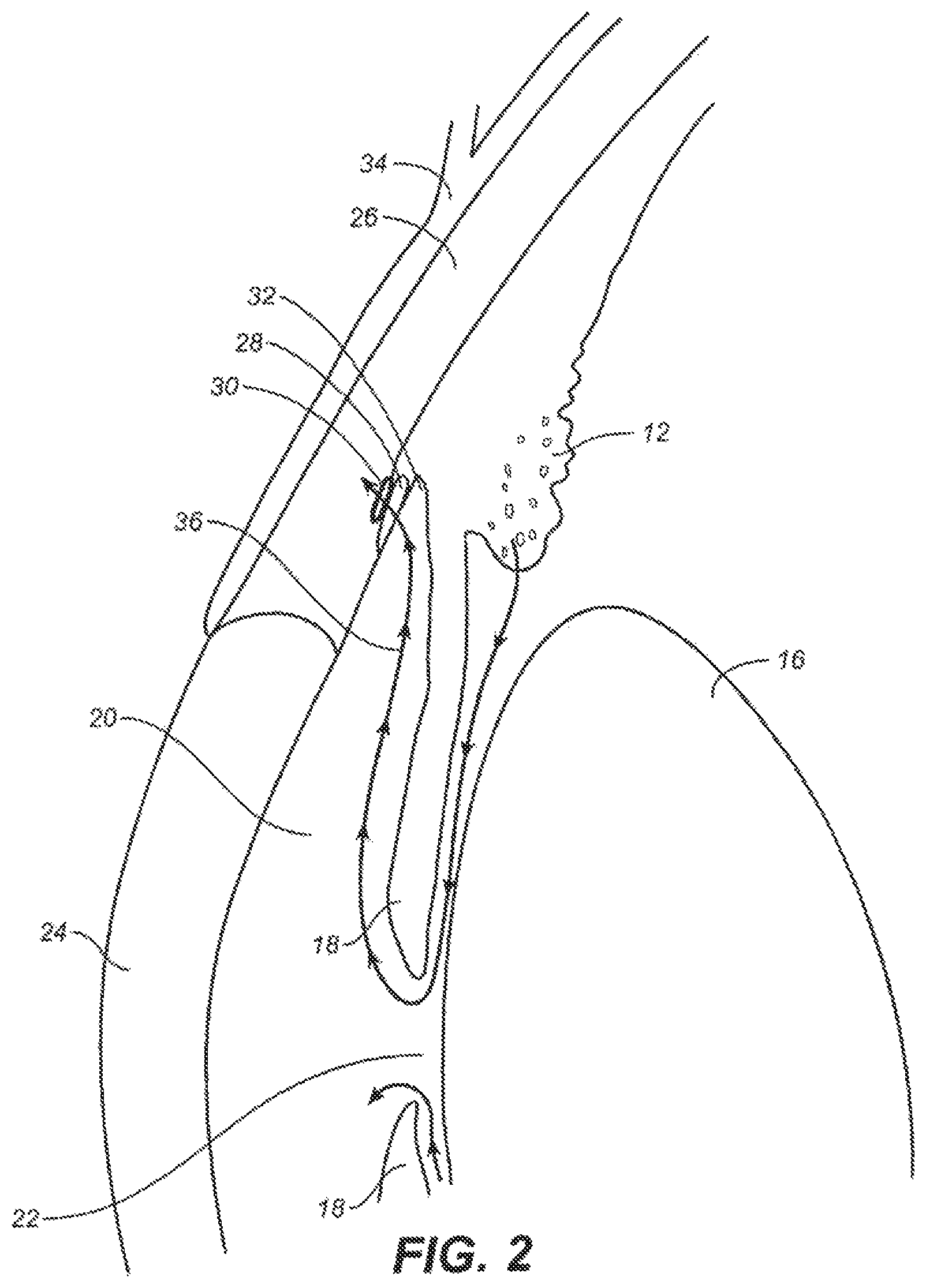 Patent US12551376 Figure 2 – Intraocular implants and methods and kits therefor