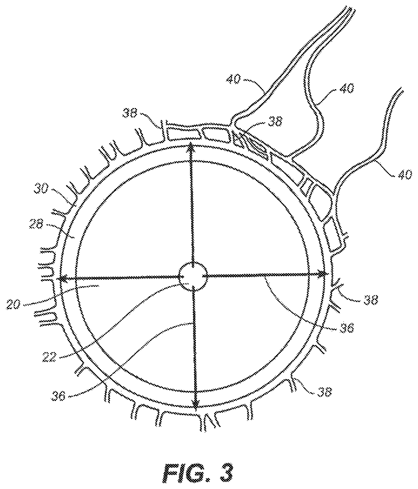 Patent US12551376 Figure 3 – Intraocular implants and methods and kits therefor