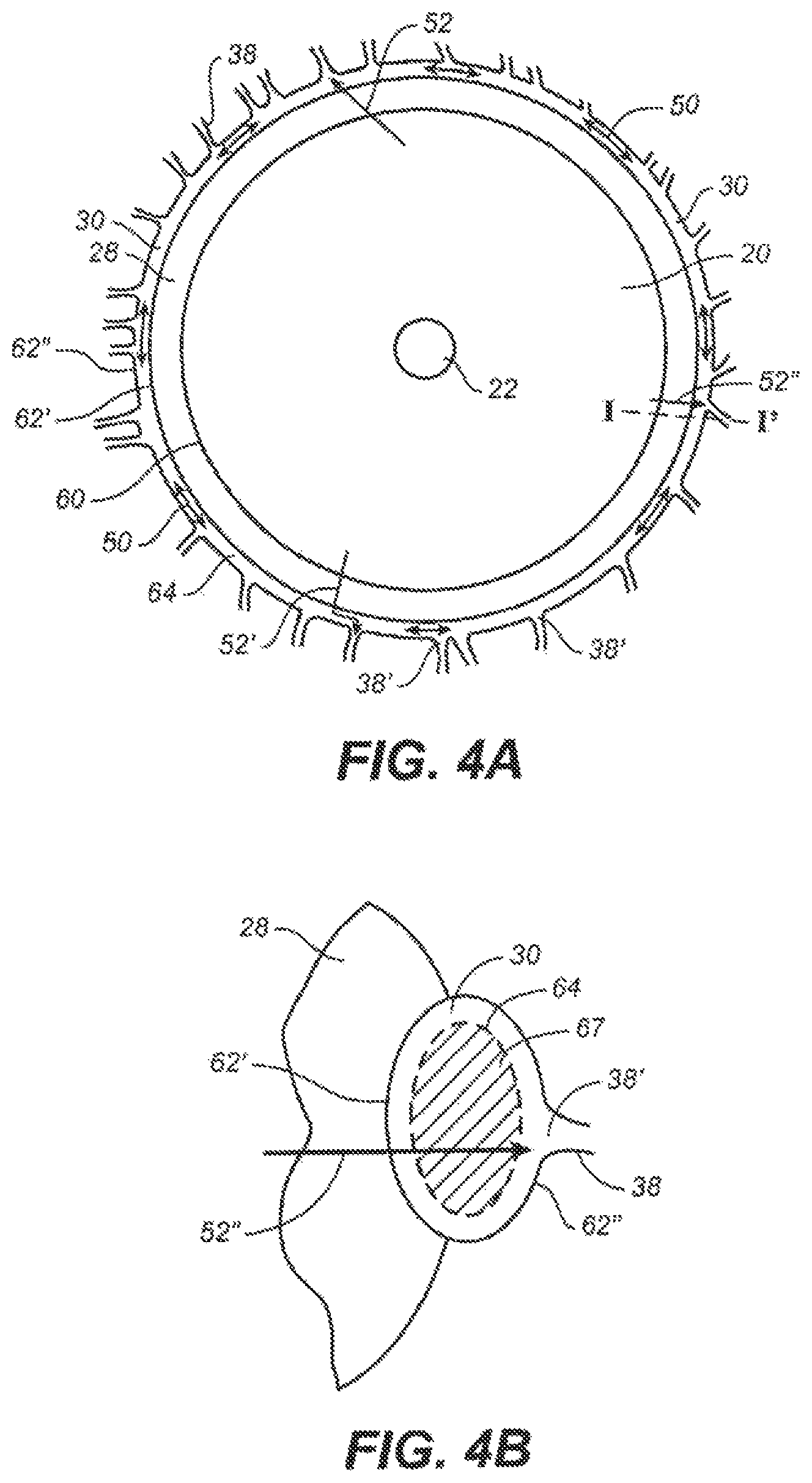 Patent US12551376 Figure 4 – Intraocular implants and methods and kits therefor