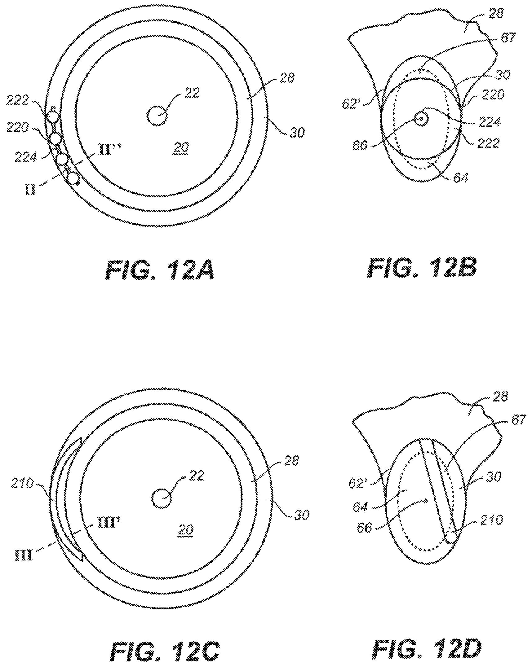 Patent US12551376 Figure 14 – Intraocular implants and methods and kits therefor