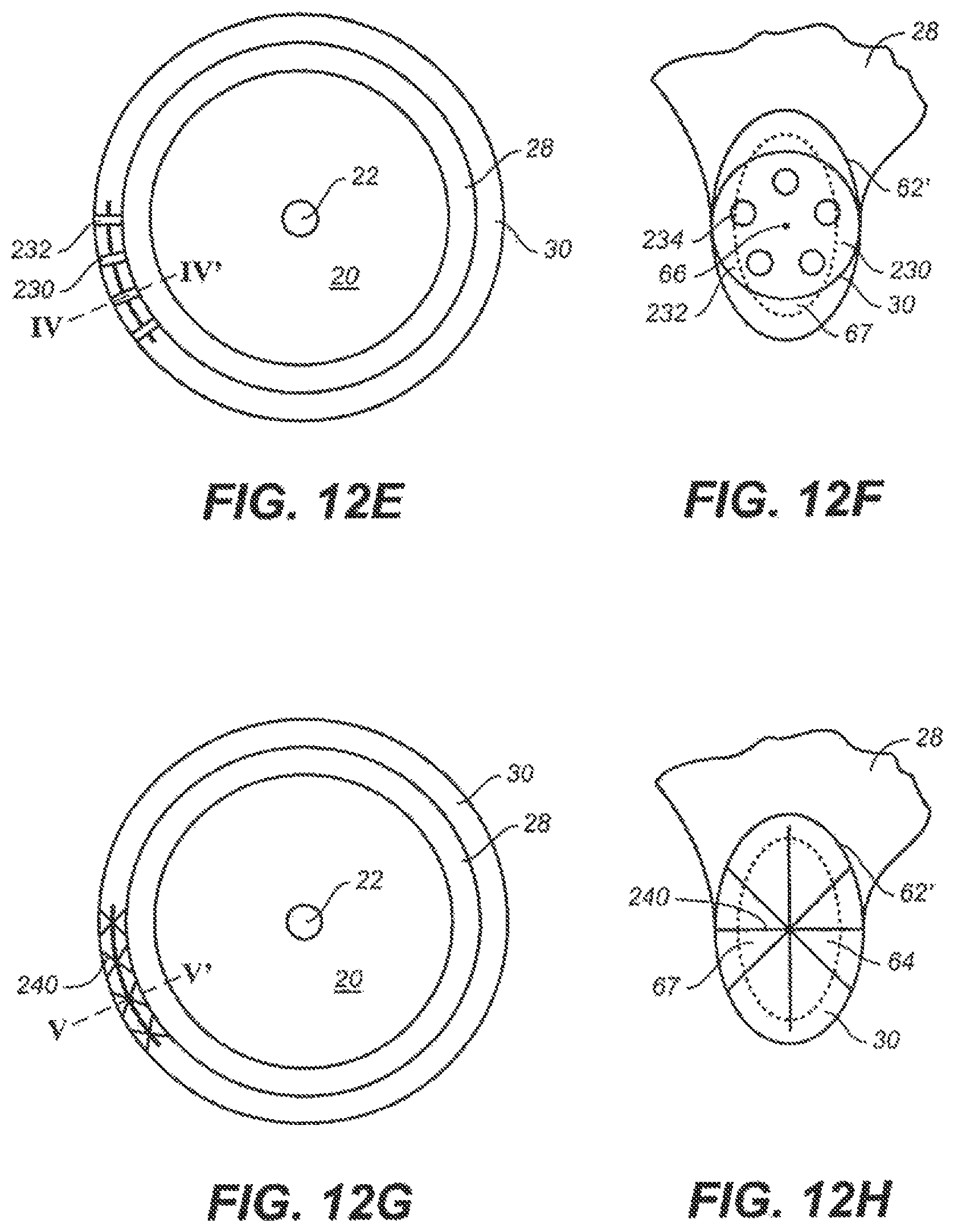 Patent US12551376 Figure 15 – Intraocular implants and methods and kits therefor