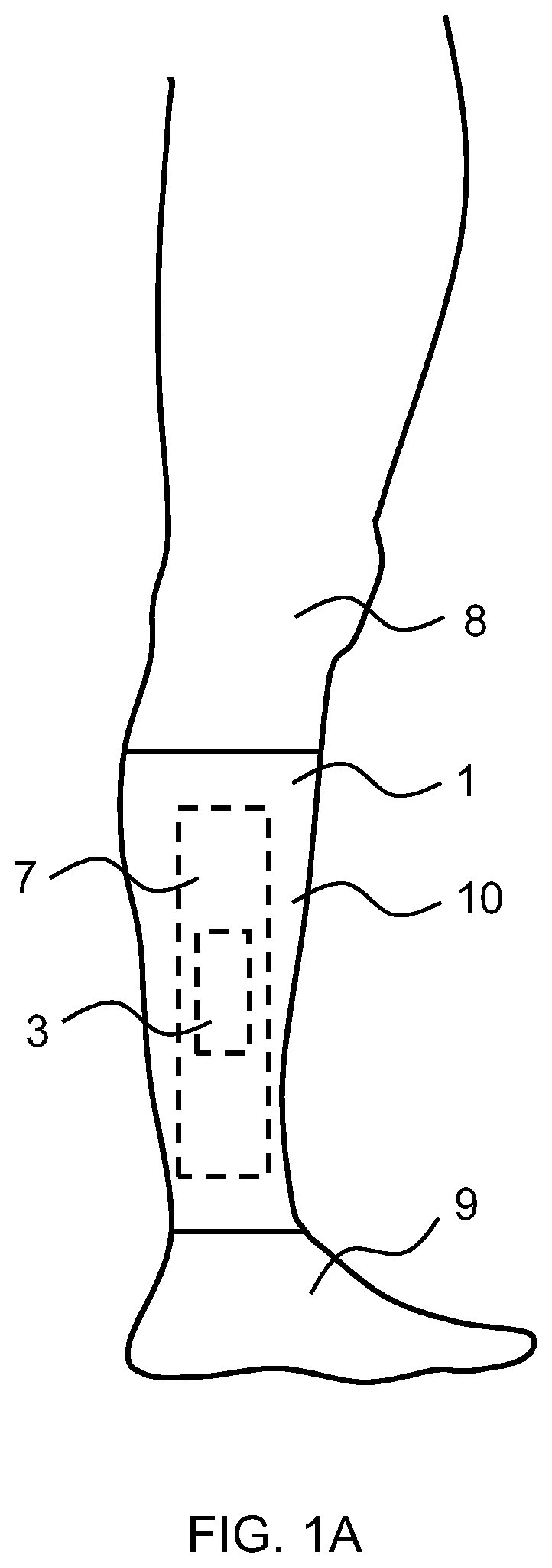 Patent US12551380 Figure 1 – Sensing device for sensing a compressive pressure