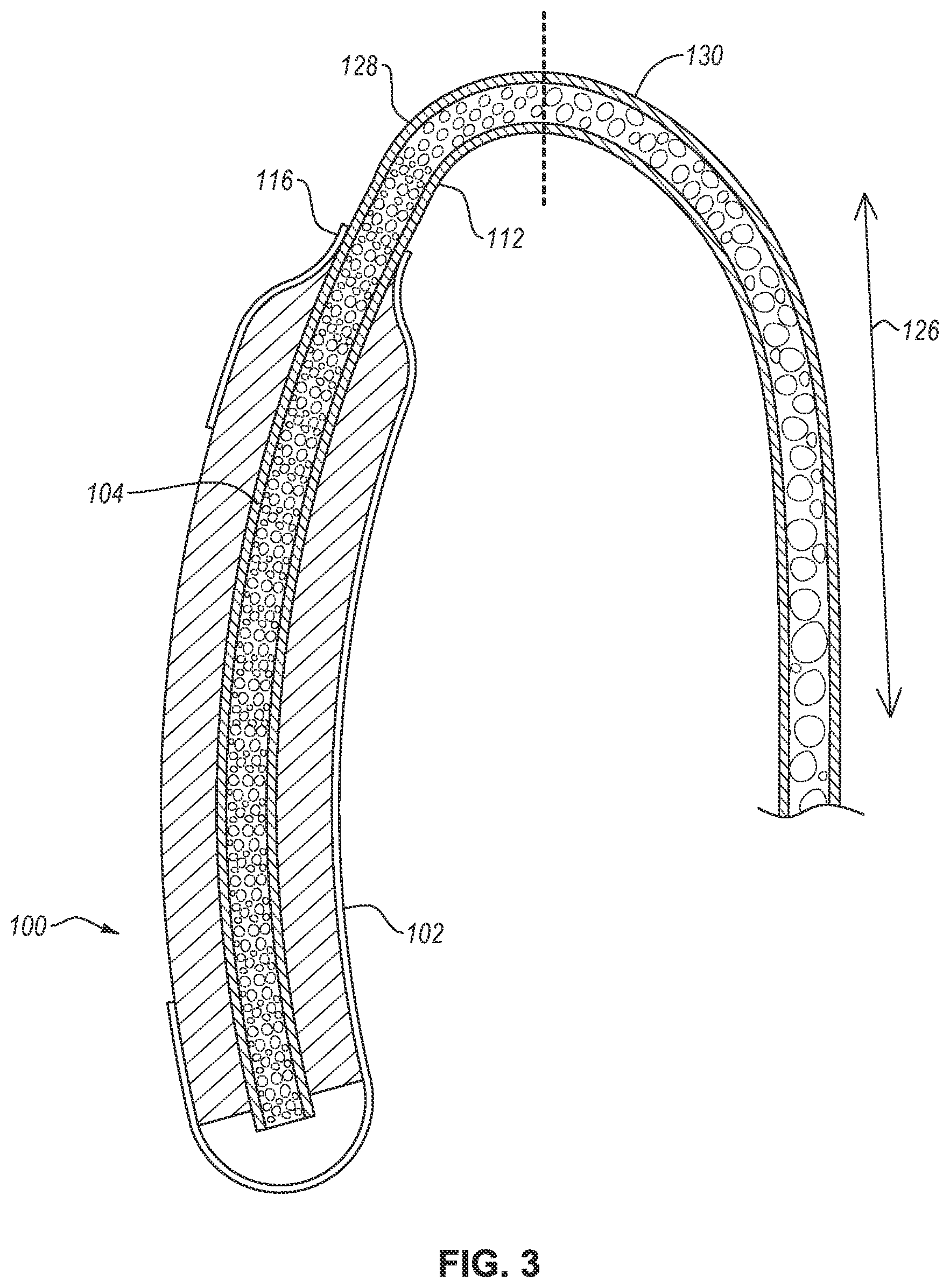 Patent US12551385 Figure 3 – Fluid collection assembly including a tube having porous wicking material for improved fluid transport