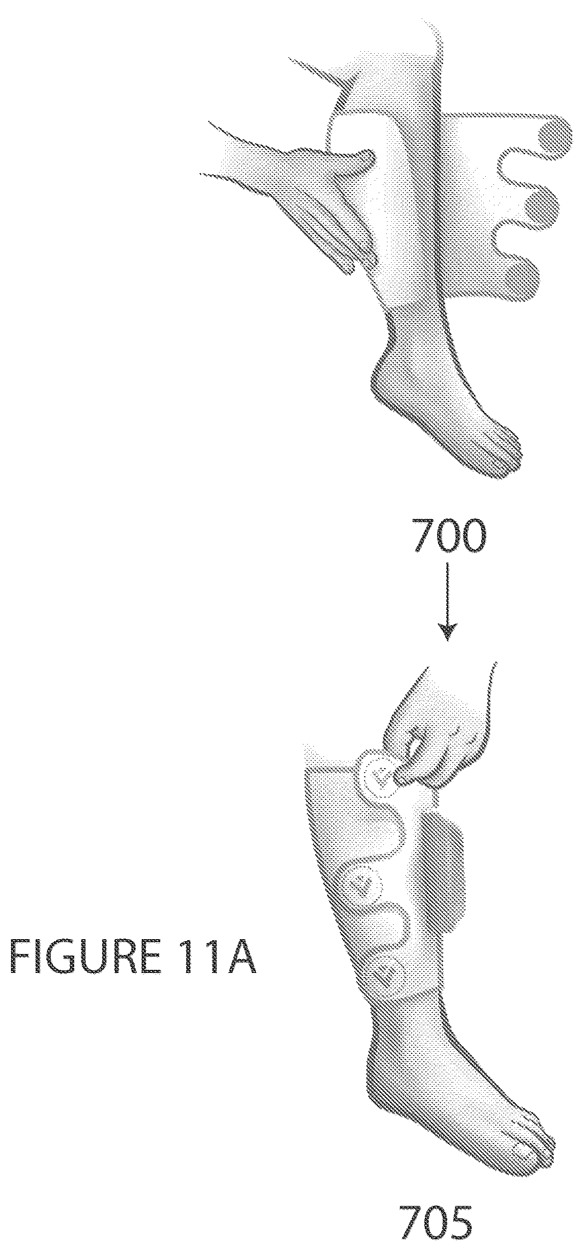 Patent US12551396 Figure 11 – Portable intermittent pneumatic compression system