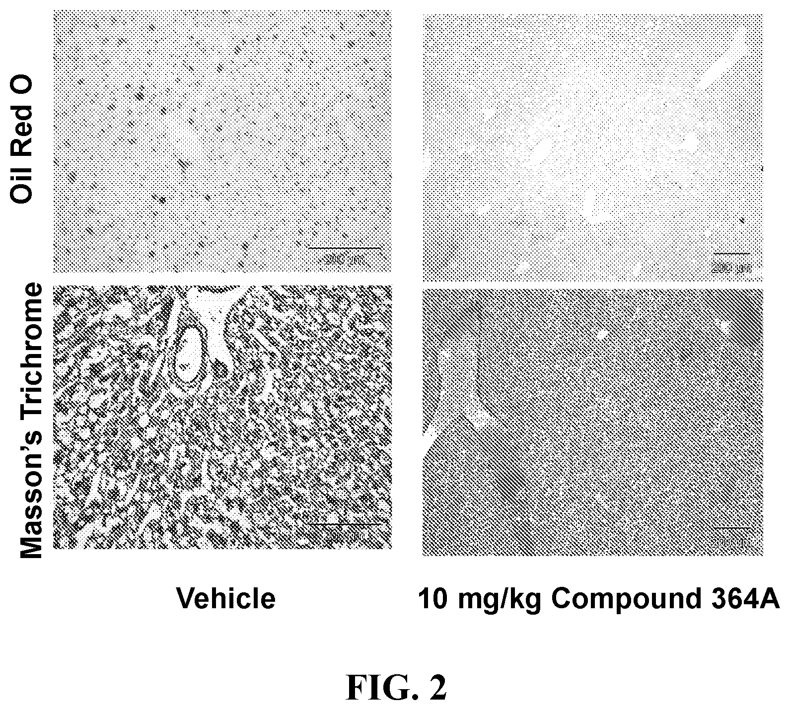Patent US12551490 Figure 2 – Heterocyclic modulators of lipid synthesis