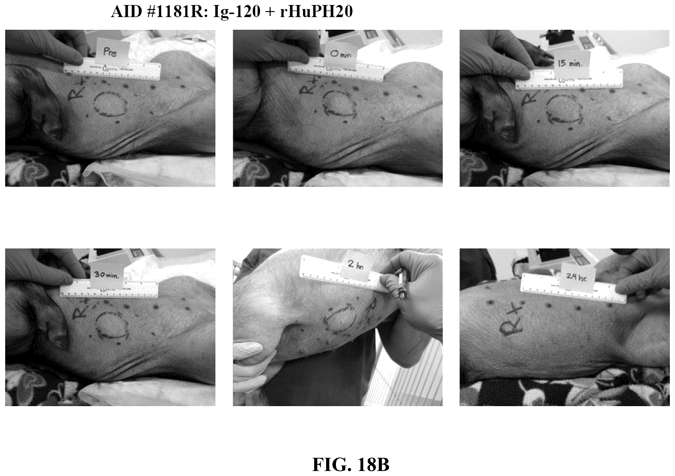 Patent US12551539 Figure 16 – Hyaluronidase enzyme formulations for high volume administration